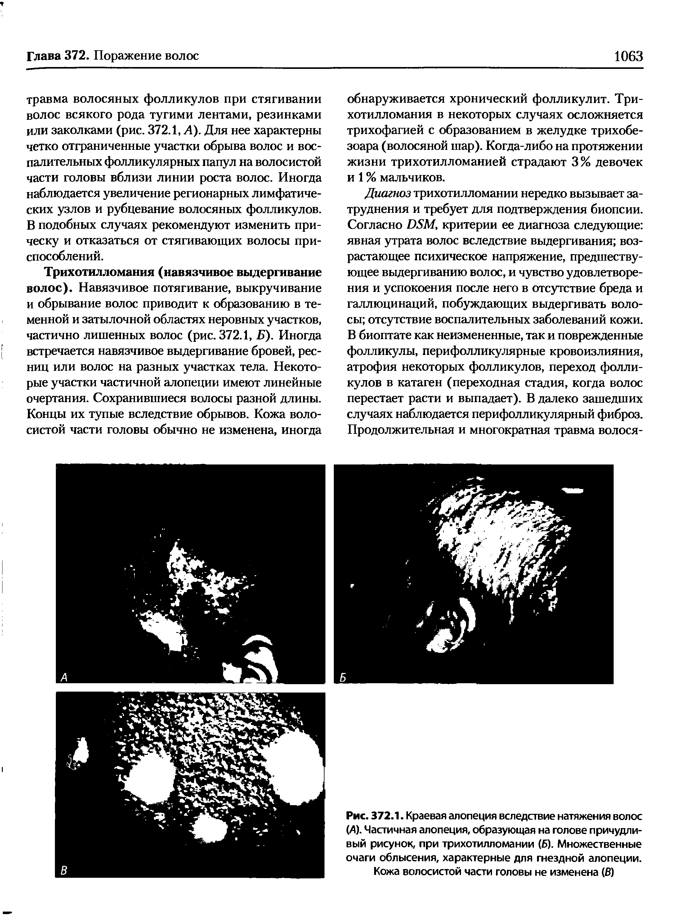 Рис. 372.1. Краевая алопеция вследствие натяжения волос (Д). Частичная алопеция, образующая на голове причудливый рисунок, при трихотилломании (Б). Множественные очаги облысения, характерные для гнездной алопеции. Кожа волосистой части головы не изменена (В)...