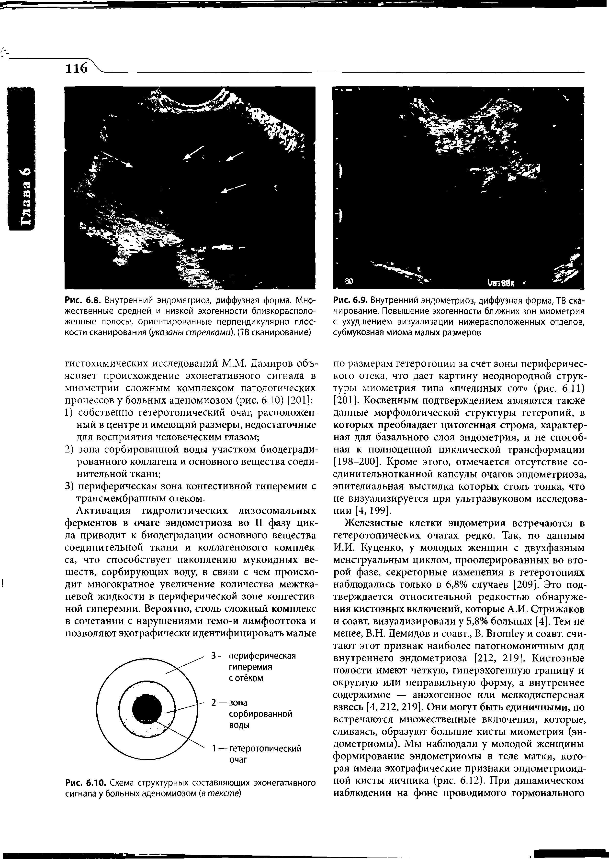 Рис. 6.10. Схема структурных составляющих эхонегативного сигнала у больных аденомиозом (в тексте)...