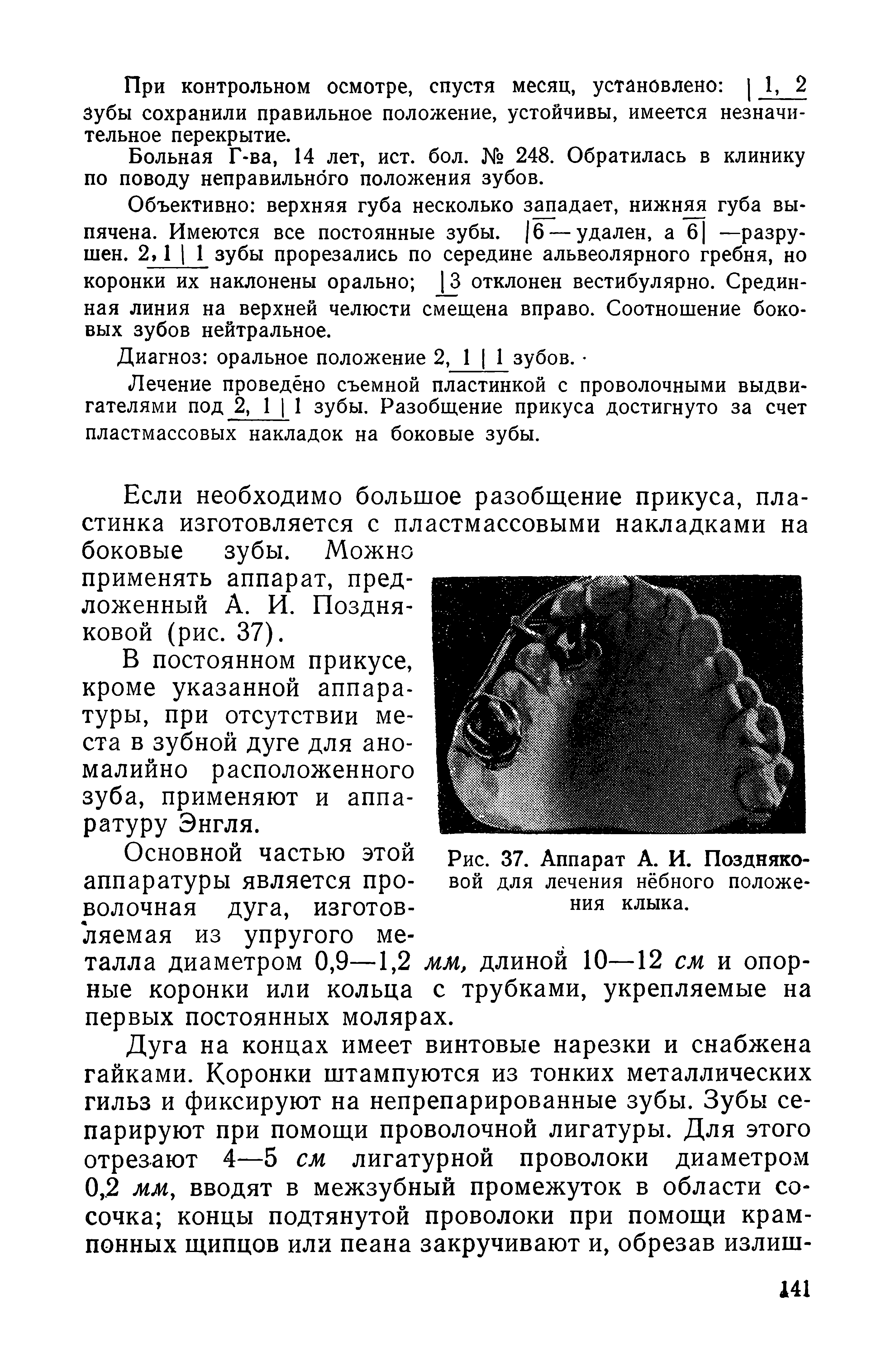 Рис. 37. Аппарат А. И. Поздняковой для лечения нёбного положения клыка.