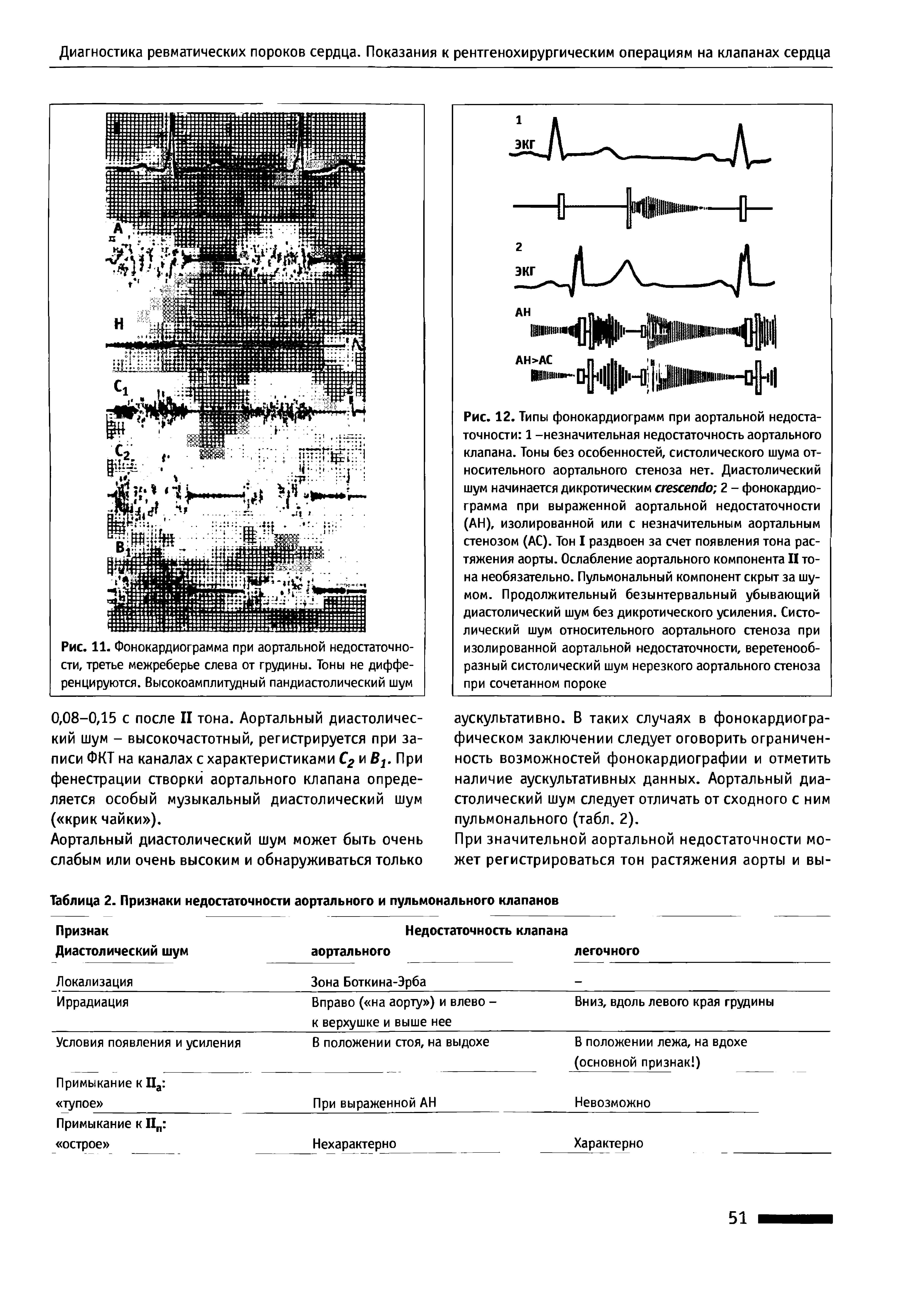 Таблица 2. Признаки недостаточности аортального и пульмонального клапанов...