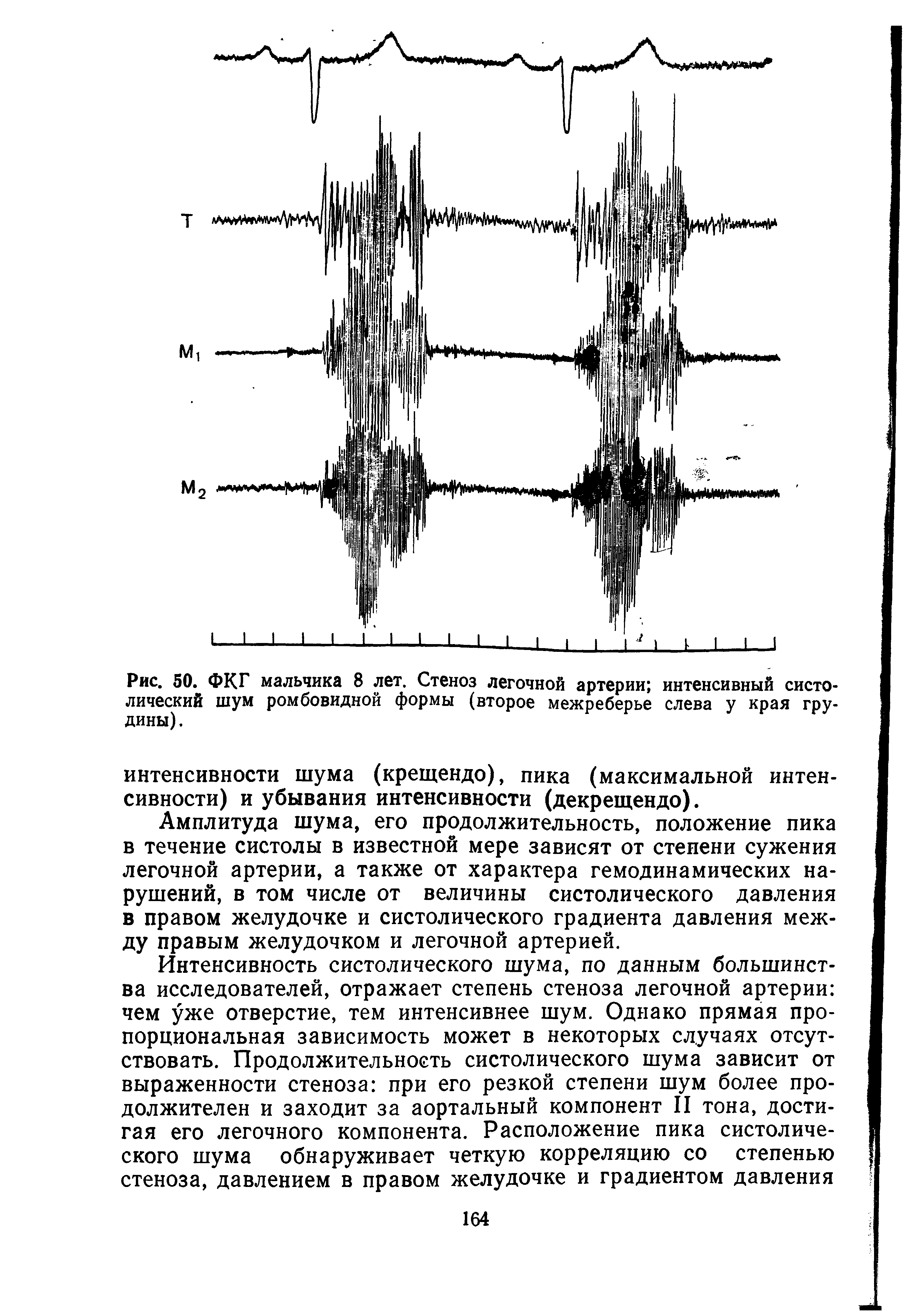 Рис. 50. ФКГ мальчика 8 лет. Стеноз легочной артерии интенсивный систолический шум ромбовидной формы (второе межреберье слева у края грудины).