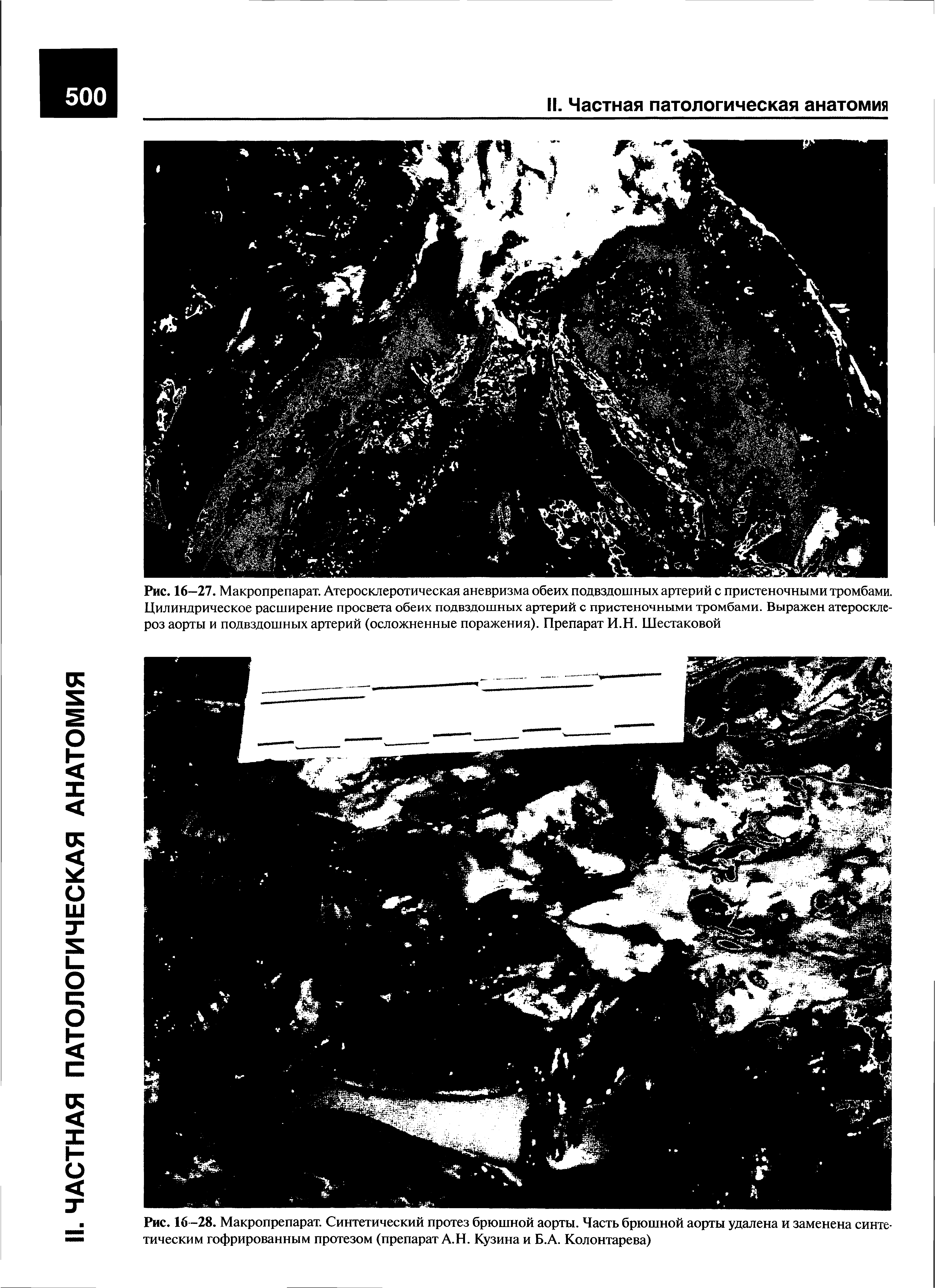 Рис. 16-28. Макропрепарат. Синтетический протез брюшной аорты. Часть брюшной аорты удалена и заменена синтетическим гофрированным протезом (препарат А.Н. Кузина и Б.А. Колонтарева)...