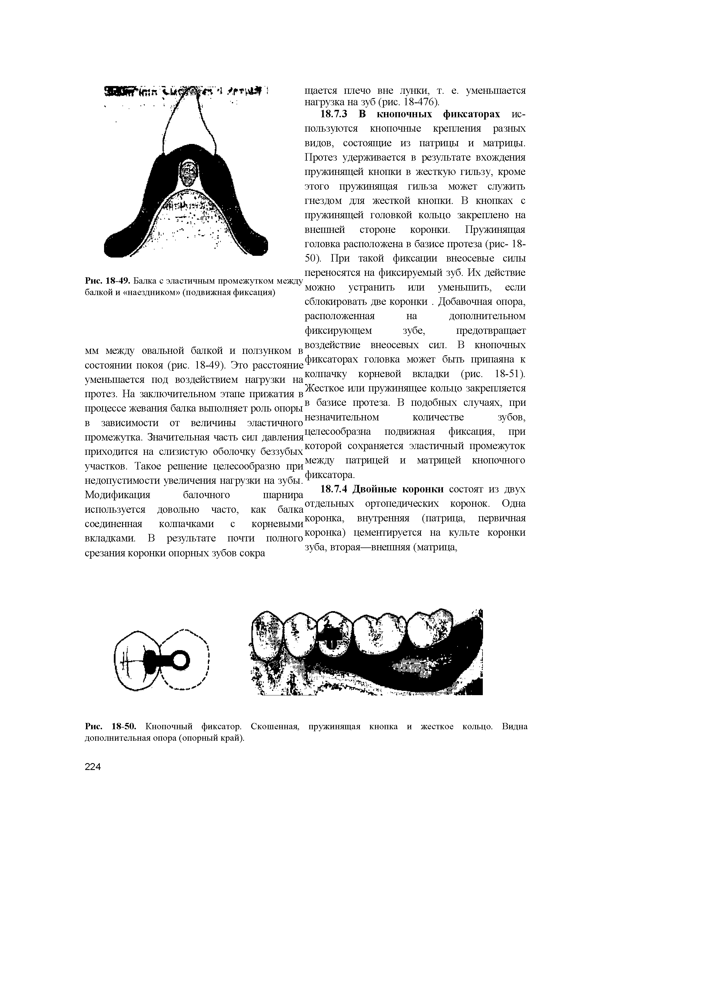 Рис. 18-50. Кнопочный фиксатор. Скошенная, пружинящая кнопка и жесткое кольцо. Видна дополнительная опора (опорный край).