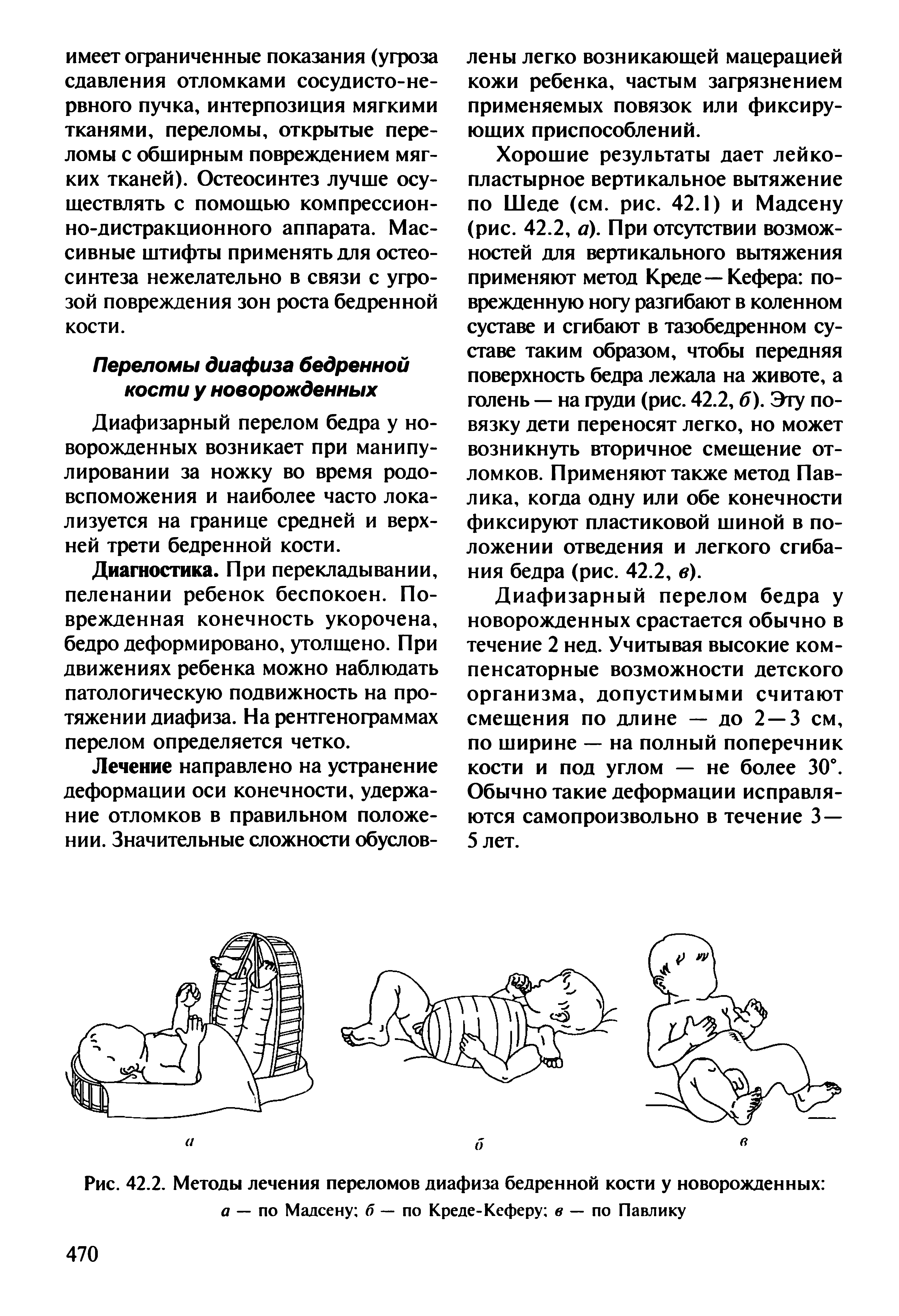 Рис. 42.2. Методы лечения переломов диафиза бедренной кости у новорожденных а — по Мадсену б — по Креде-Кеферу в — по Павлику...