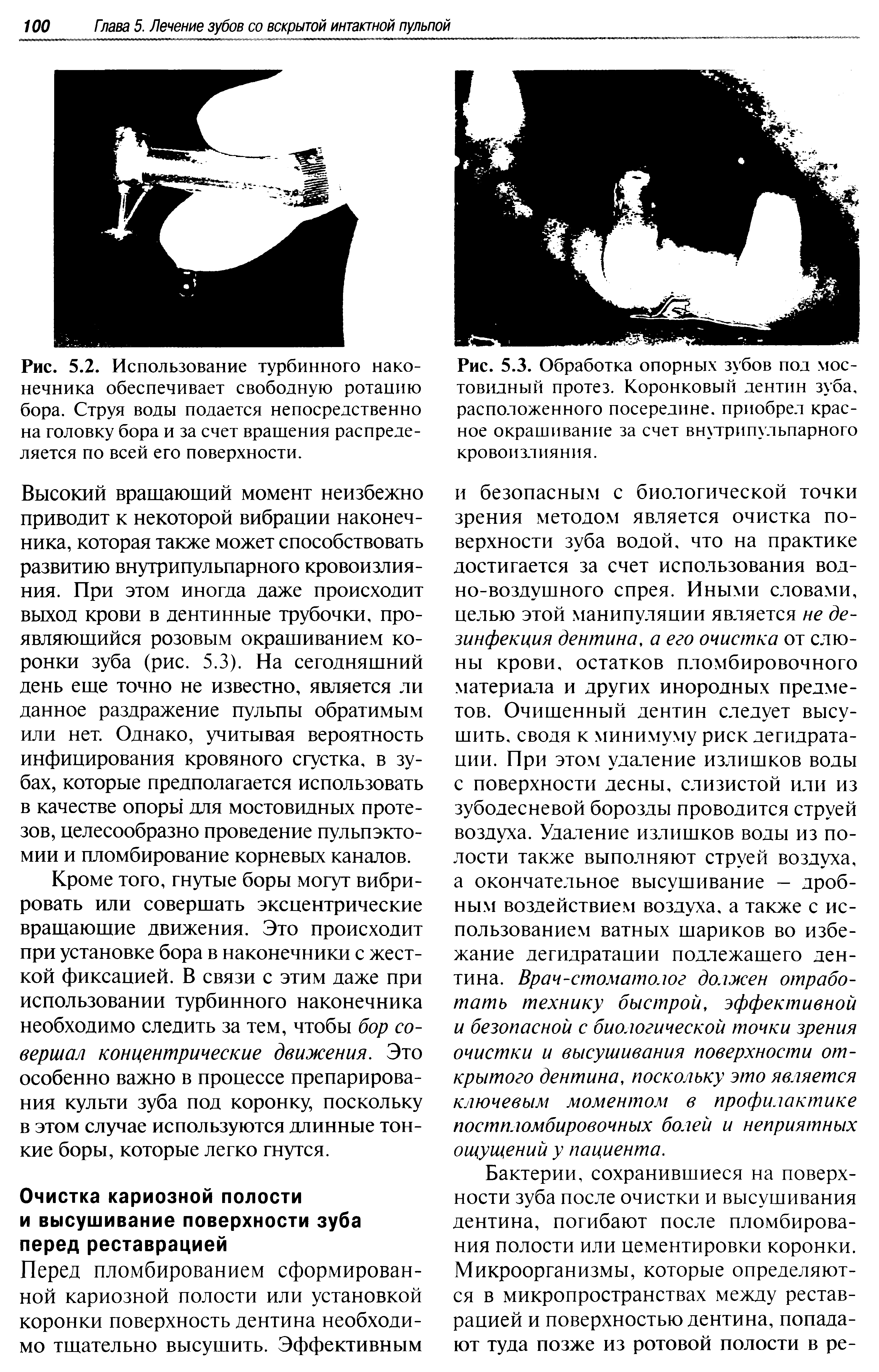 Рис. 5.3. Обработка опорных зубов под мостовидный протез. Коронковый дентин зуба, расположенного посередине, приобрел красное окрашивание за счет внутрипульпарного кровоизлияния.