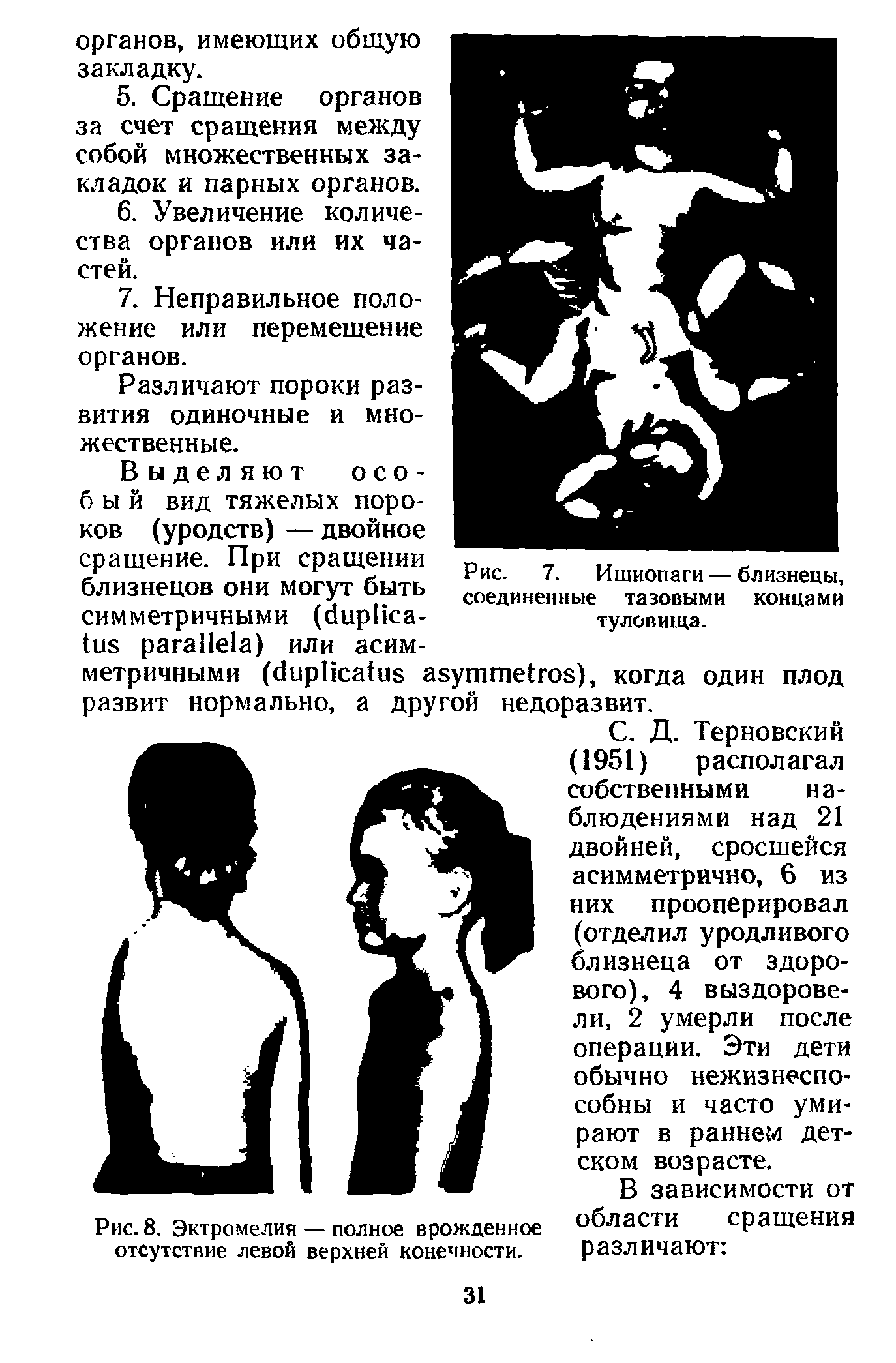 Рис. 7. Ишиопаги — близнецы, соединенные тазовыми концами туловища.