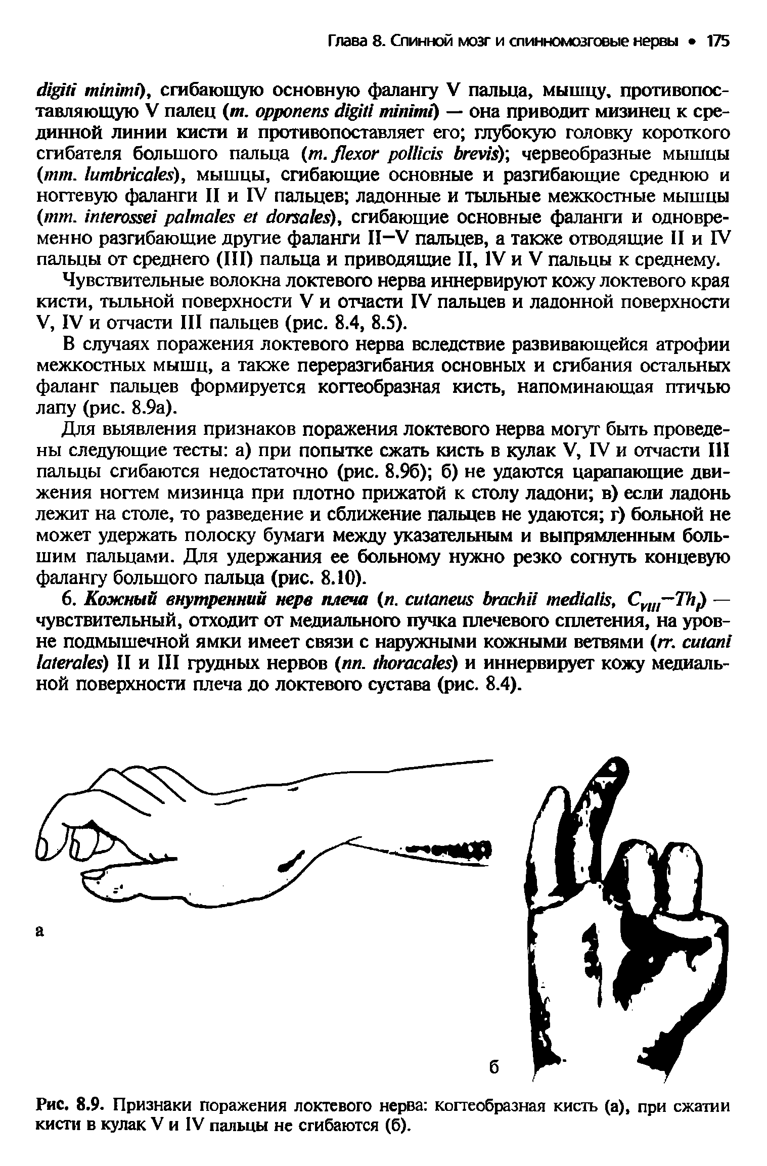 Рис. 8.9. Признаки поражения локтевого нерва когтеобразная кисть (а), при сжатии кисти в кулак V и IV пальцы не сгибаются (б).