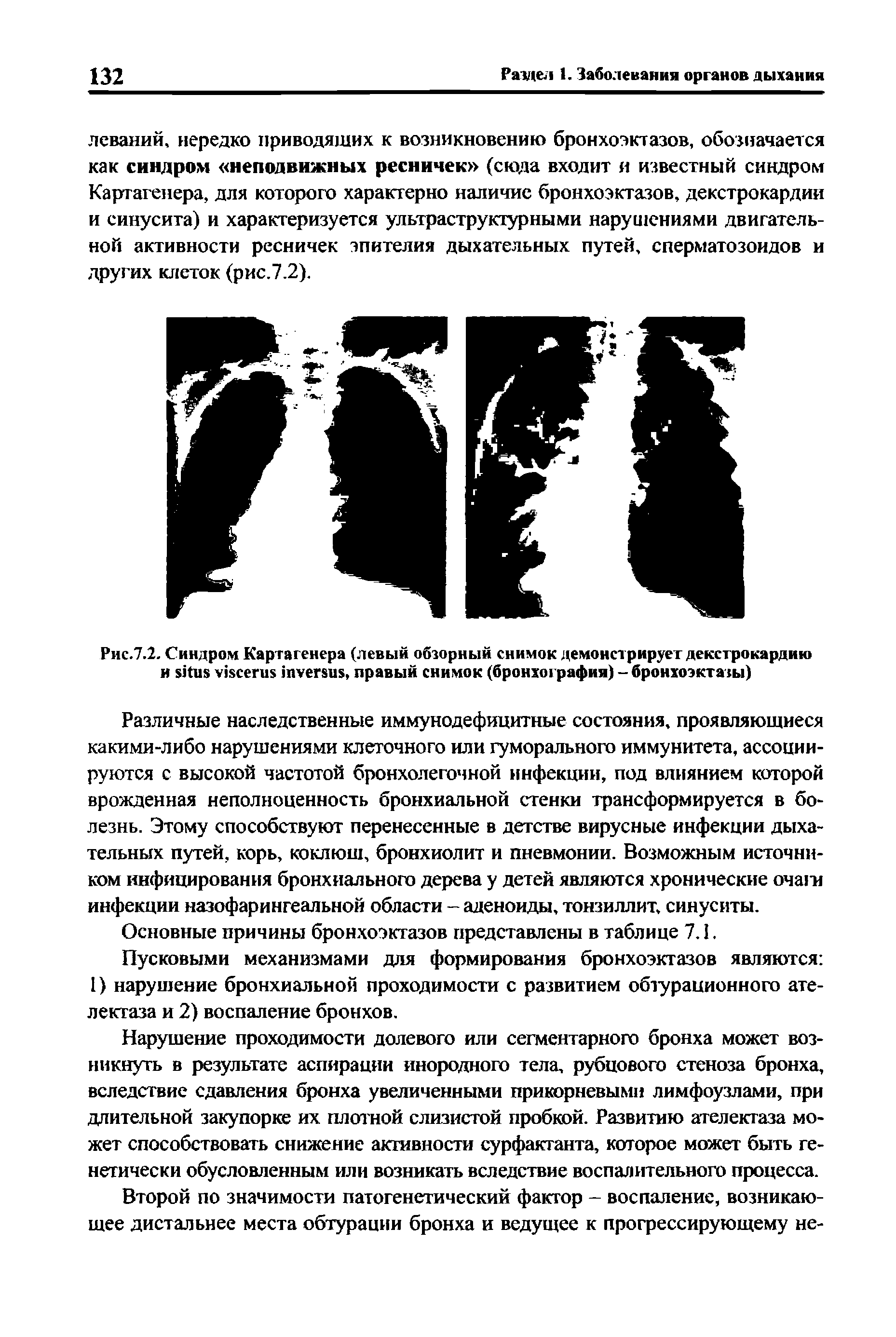 Рис.7.2. Синдром Картагенера (левый обзорный снимок демонстрирует декстрокардию и , правый снимок (бронхография) - бронхоэктазы)...