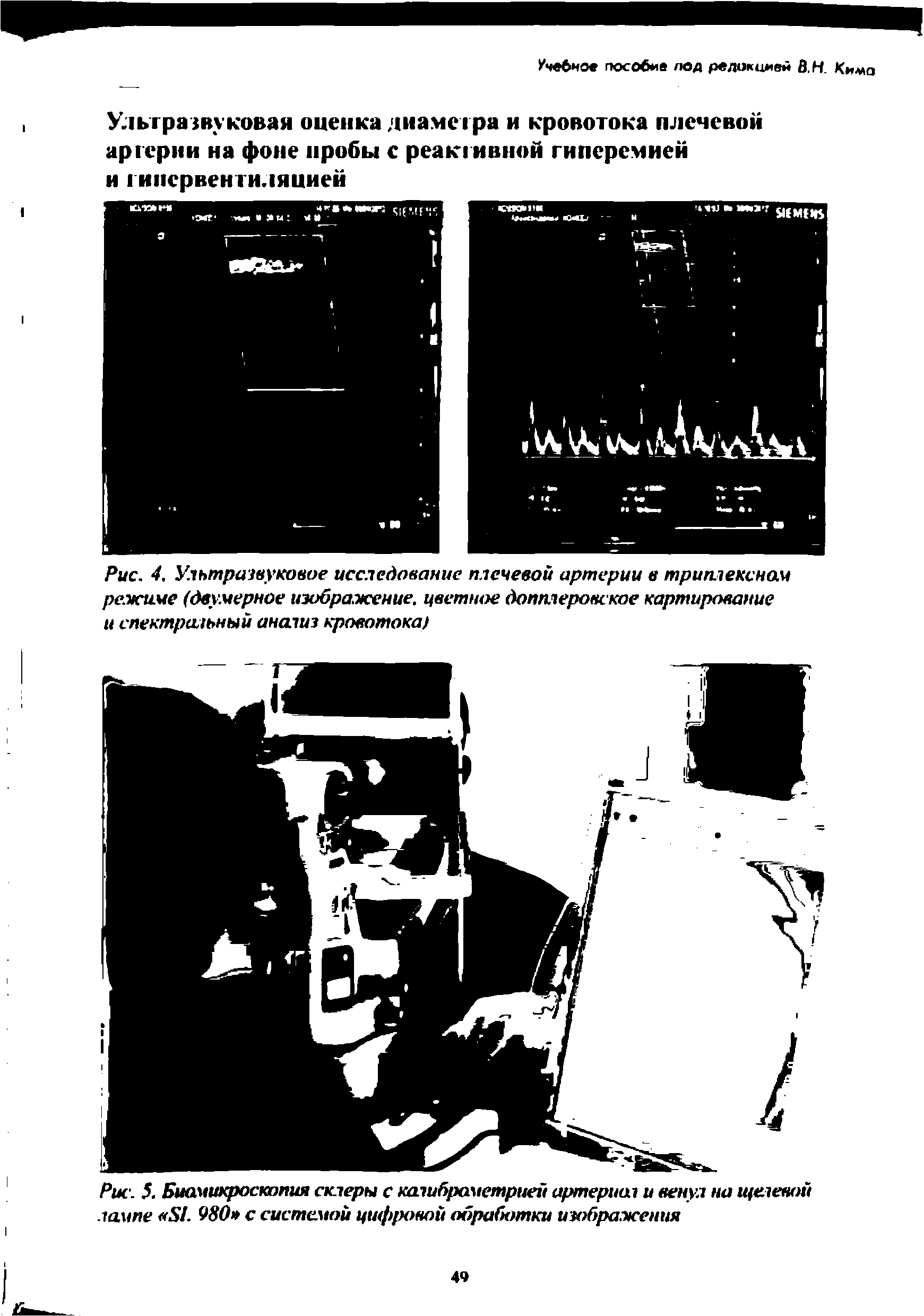 Рис. 4. Ультразвуковое исследование плечевой артерии в триплексном режиме (двумерное изображение, цветное допплеровское картирование и спектразьный аназиз кровотока)...