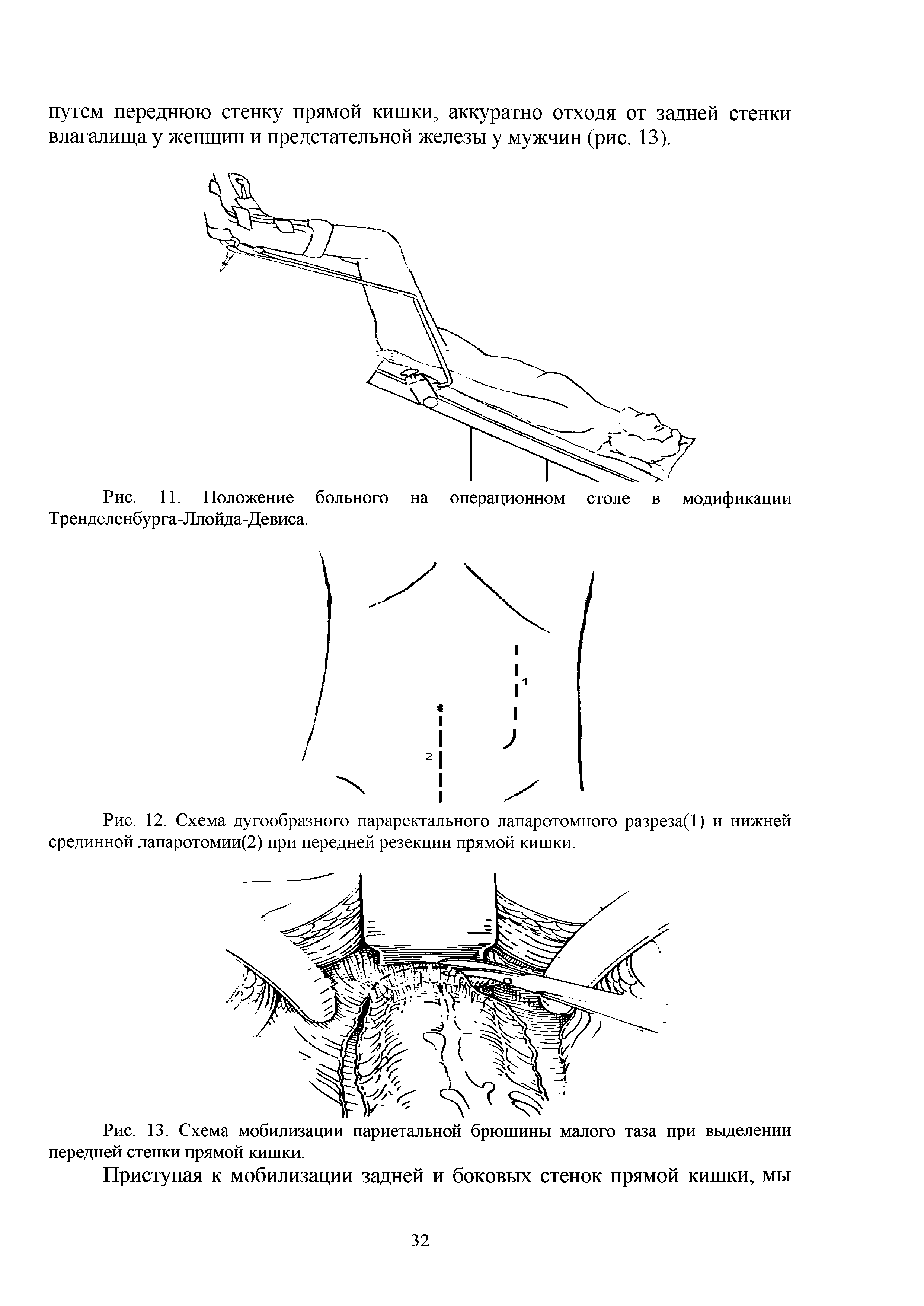 Рис. 12. Схема дугообразного параректального лапаротомного разреза(1) и нижней срединной лапаротомии(2) при передней резекции прямой кишки.