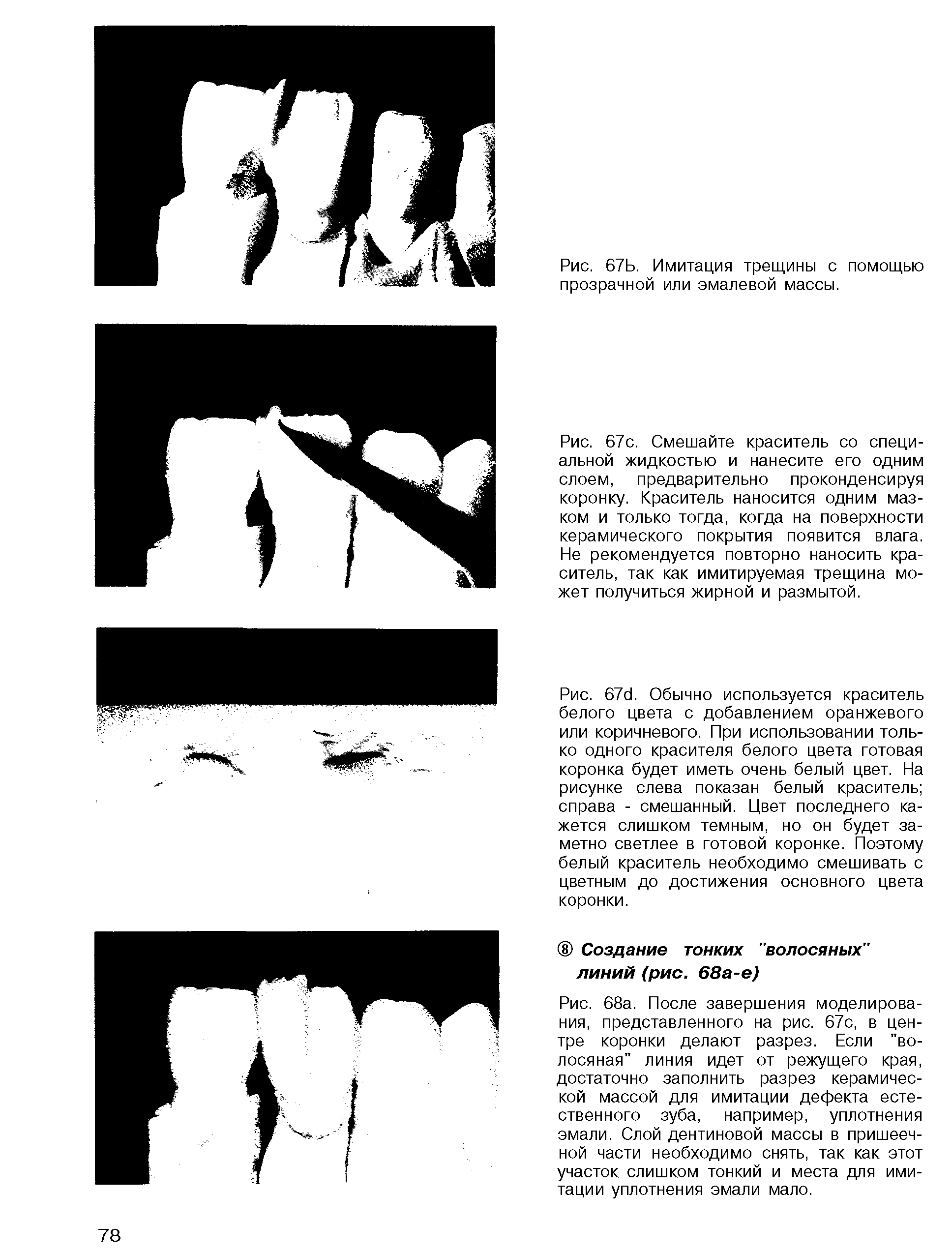Рис. 67с. Смешайте краситель со специальной жидкостью и нанесите его одним слоем, предварительно проконденсируя коронку. Краситель наносится одним мазком и только тогда, когда на поверхности керамического покрытия появится влага. Не рекомендуется повторно наносить краситель, так как имитируемая трещина может получиться жирной и размытой.