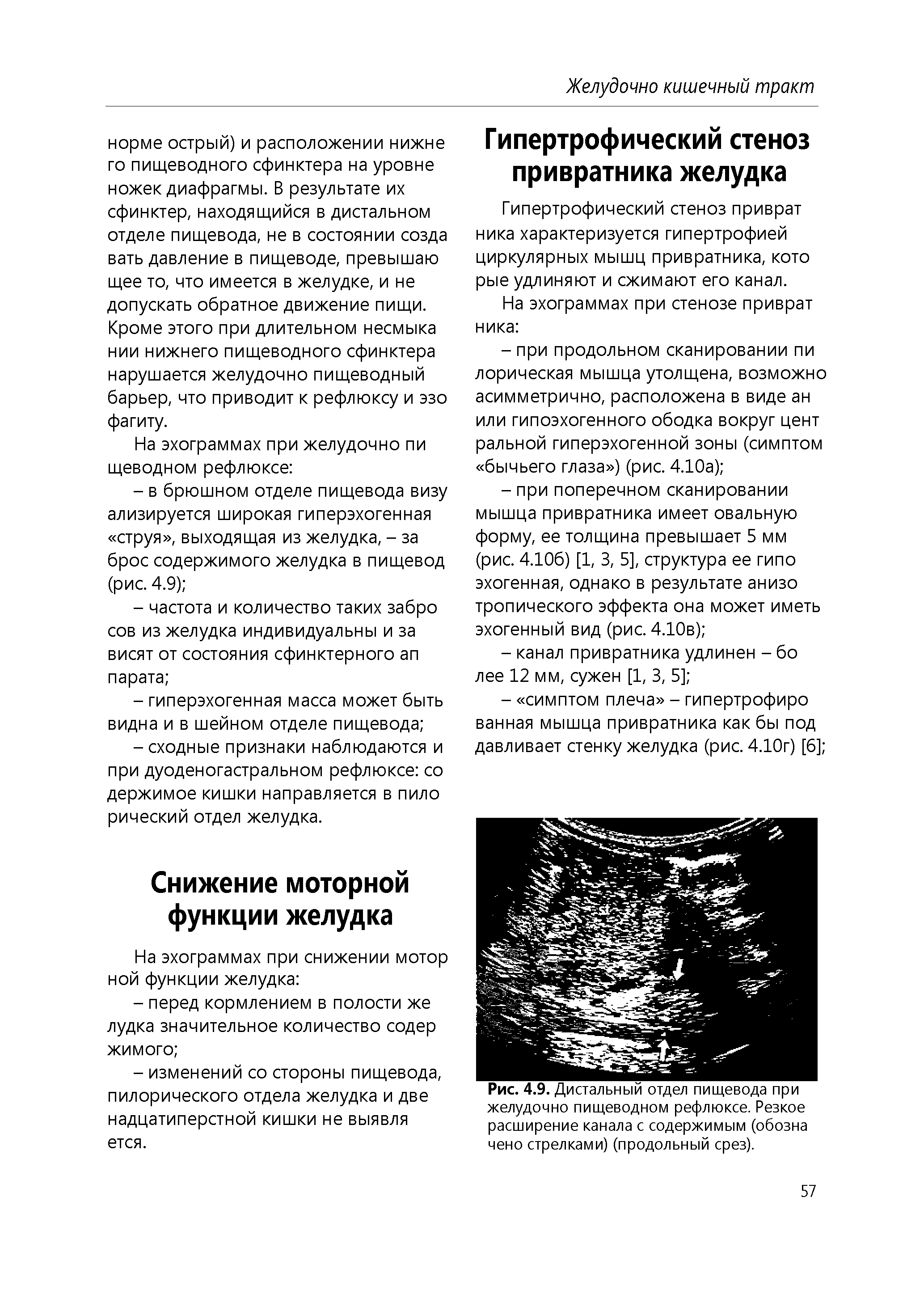 Рис. 4.9. Дистальный отдел пищевода при желудочно пищеводном рефлюксе. Резкое расширение канала с содержимым (обозна чено стрелками) (продольный срез).