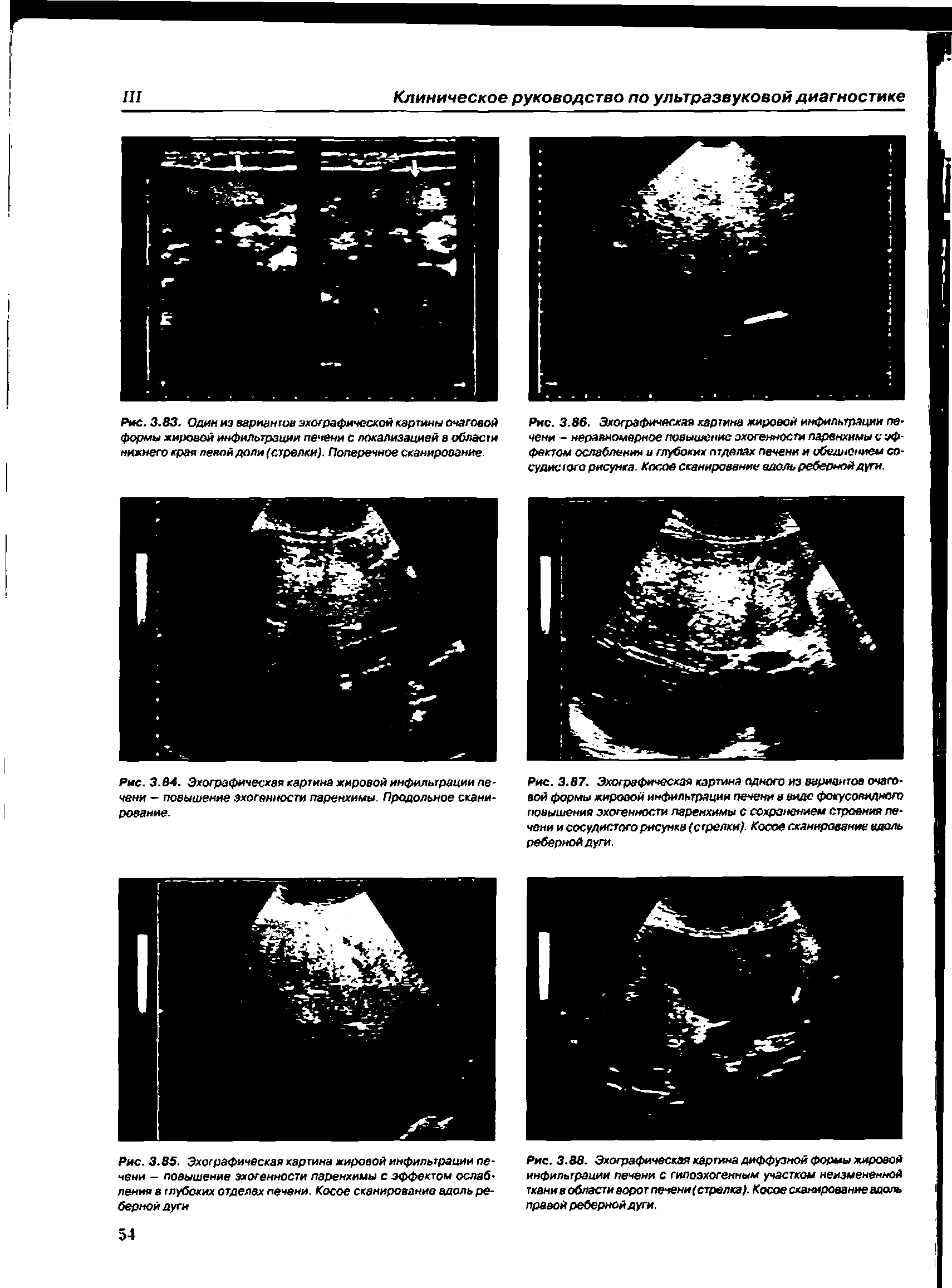 Рис. 3.88. Эхографическая картина диффузной формы жировой инфильтрации печени с гипоэхогенным участком неизмененной пани в области ворот печени(стрелка). Косое сканирование вдоль правой реберной дуги.