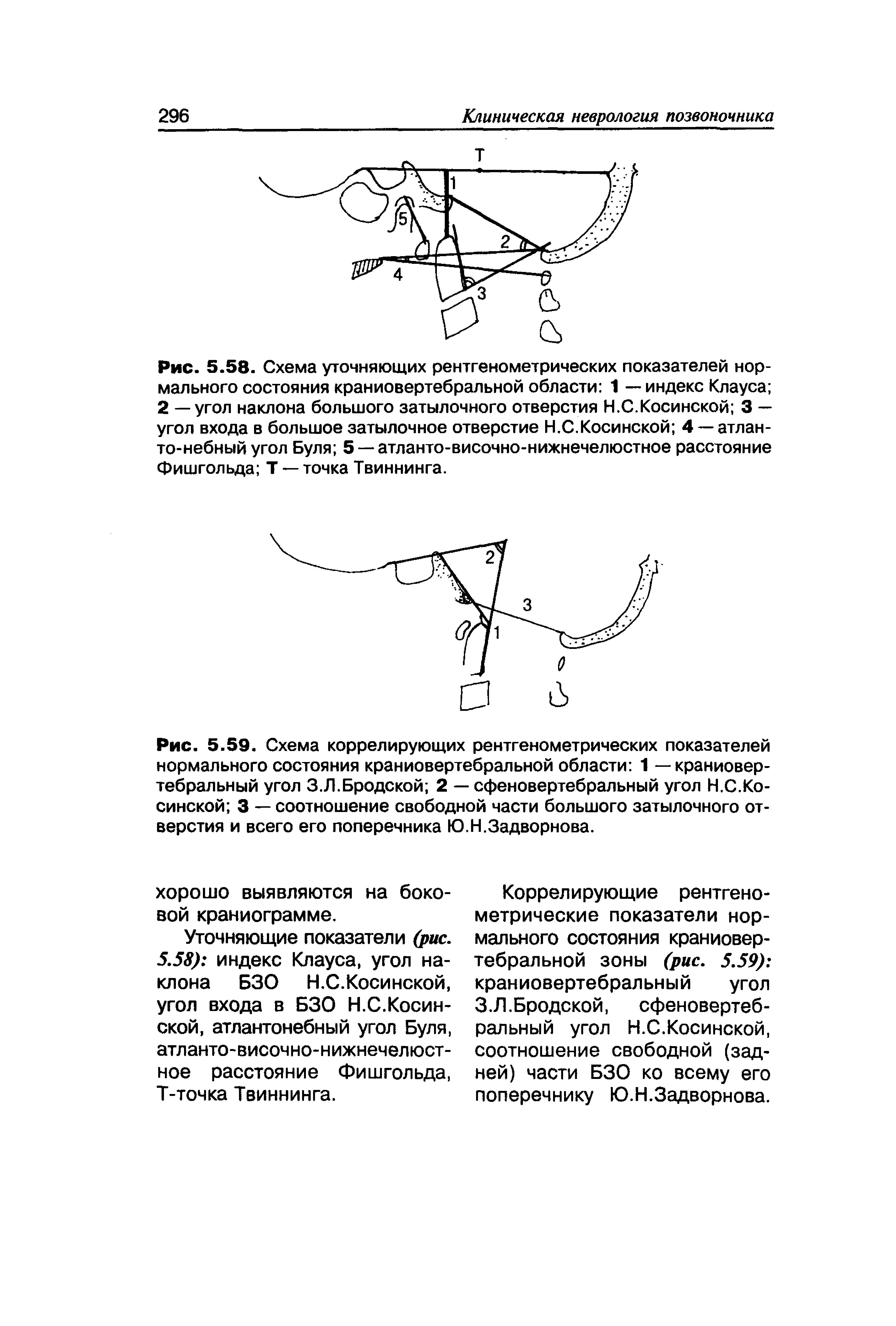 Рис. 5.59. Схема коррелирующих рентгенометрических показателей нормального состояния краниовертебральной области 1 — краниовертебральный угол З.Л.Бродской 2 — сфеновертебральный угол Н.С.Косинской 3 — соотношение свободной части большого затылочного отверстия и всего его поперечника Ю.Н.Задворнова.