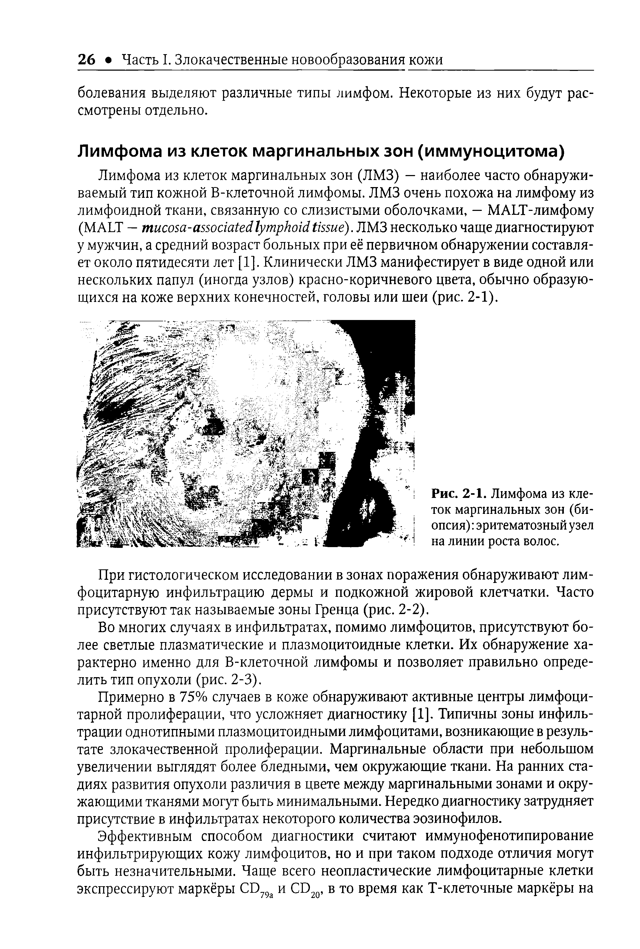 Рис. 2-1. Лимфома из клеток маргинальных зон (биопсия) эритематозный узел на линии роста волос.