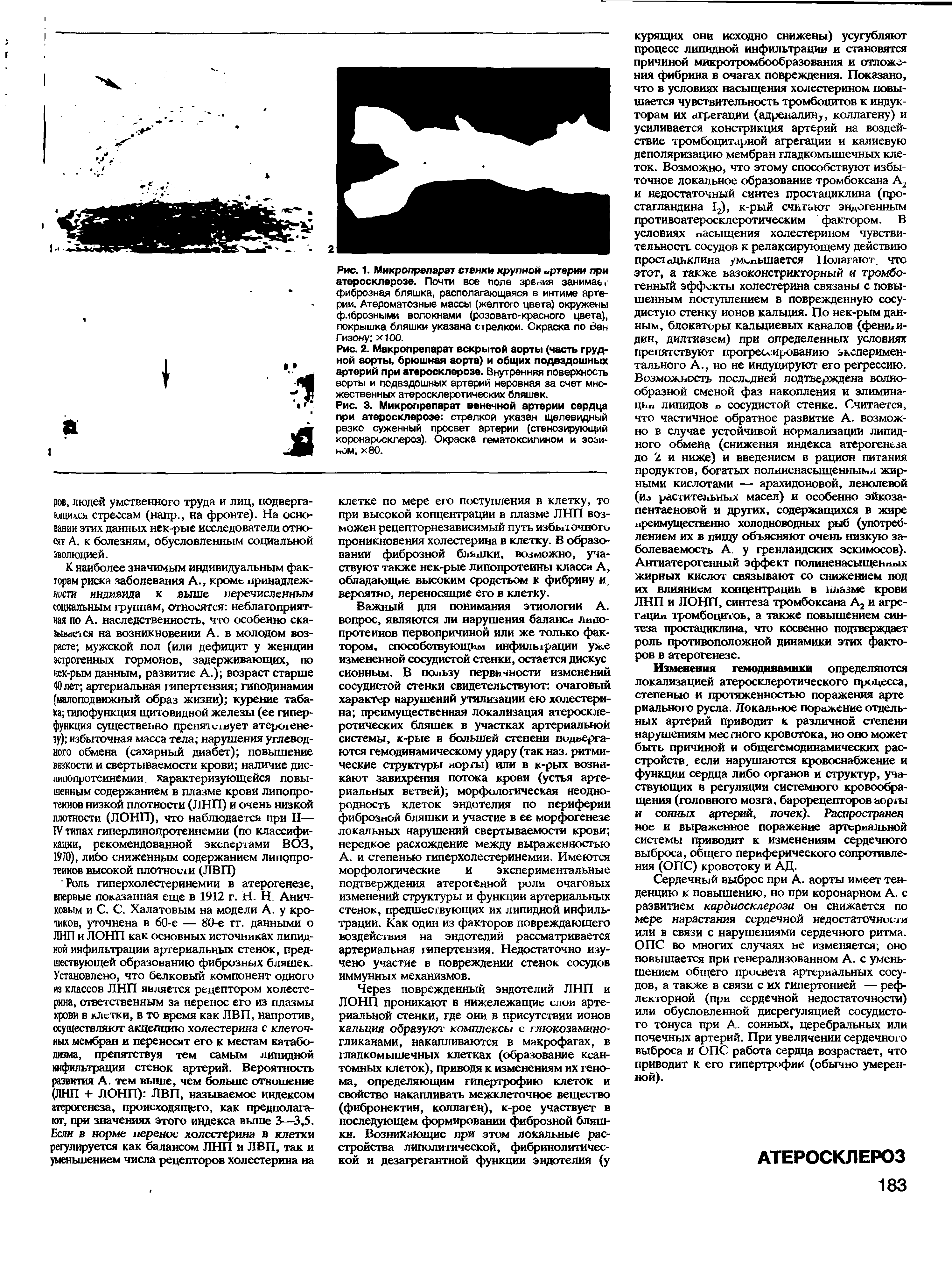 Рис. 2. Макропрепарат вскрытой аорты (часть грудной аорты, брюшная аорта) и общих подвздошных артерий при атеросклерозе. Внутренняя поверхность аорты и подвздошных артерий неровная за счет множественных атеросклеротических бляшек.