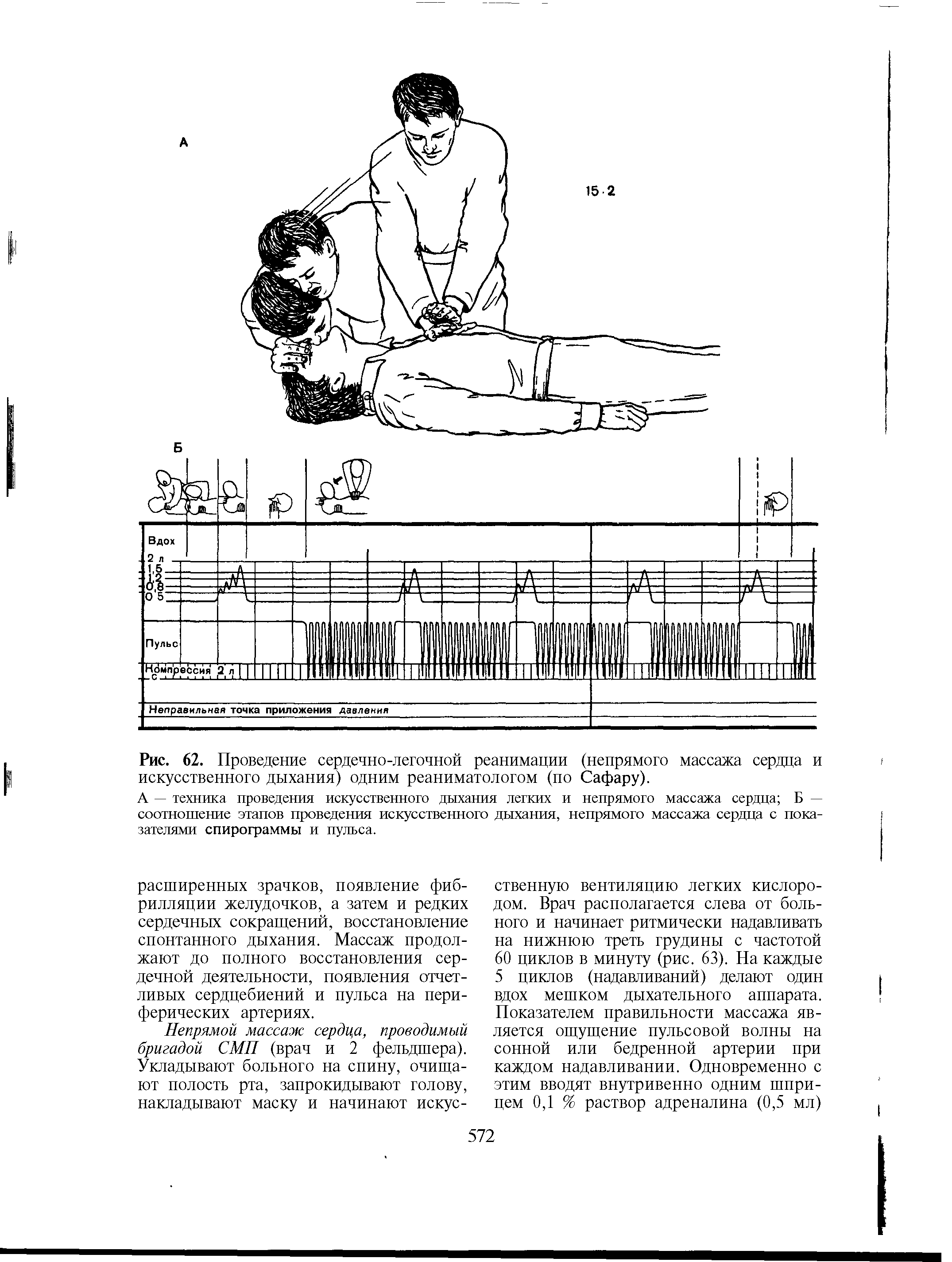 Рис. 62. Проведение сердечно-легочной реанимации (непрямого массажа сердца и искусственного дыхания) одним реаниматологом (по Сафару).