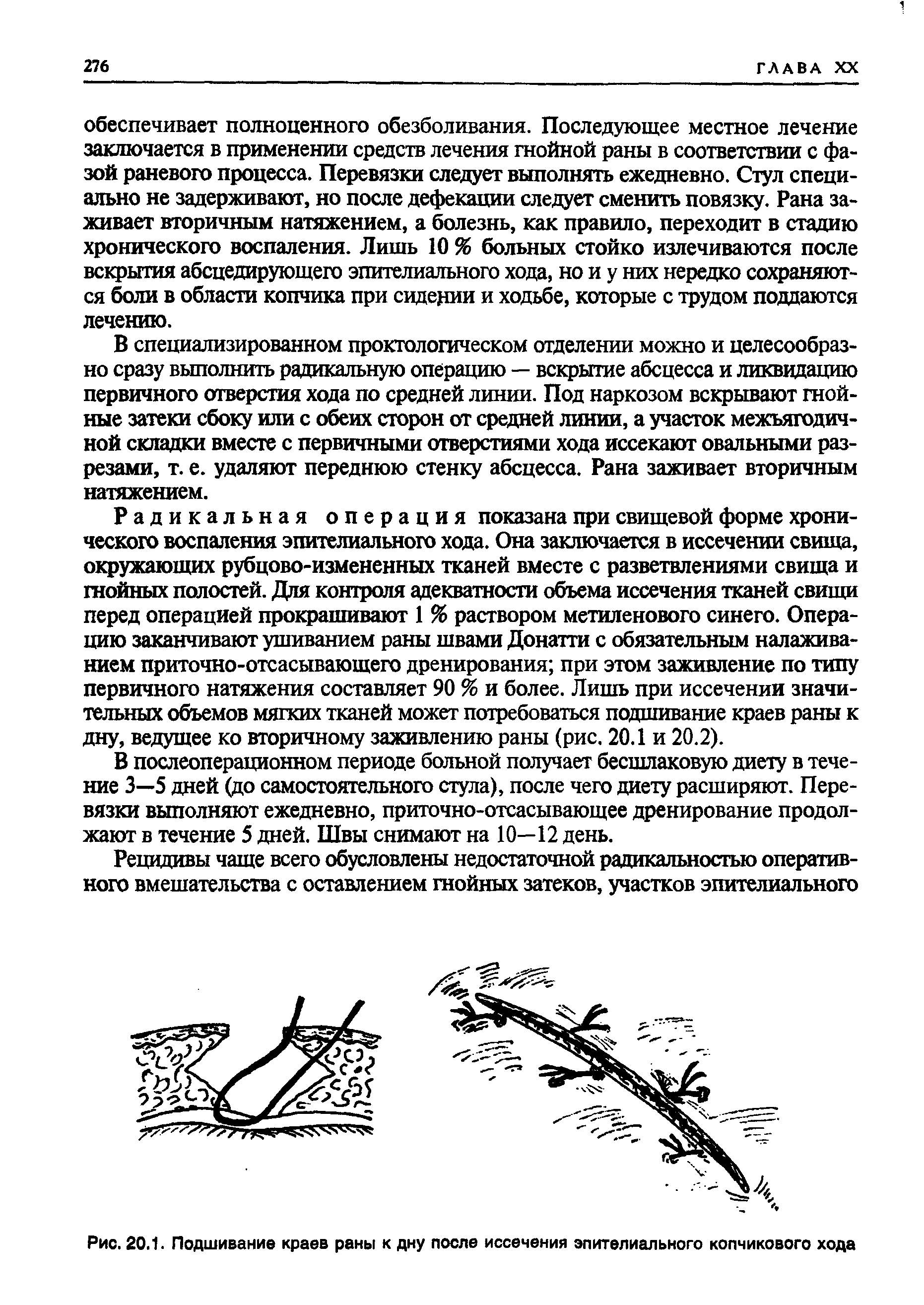 Рис. 20.1. Подшивание краев раны к дну после иссечения эпителиального копчикового хода...