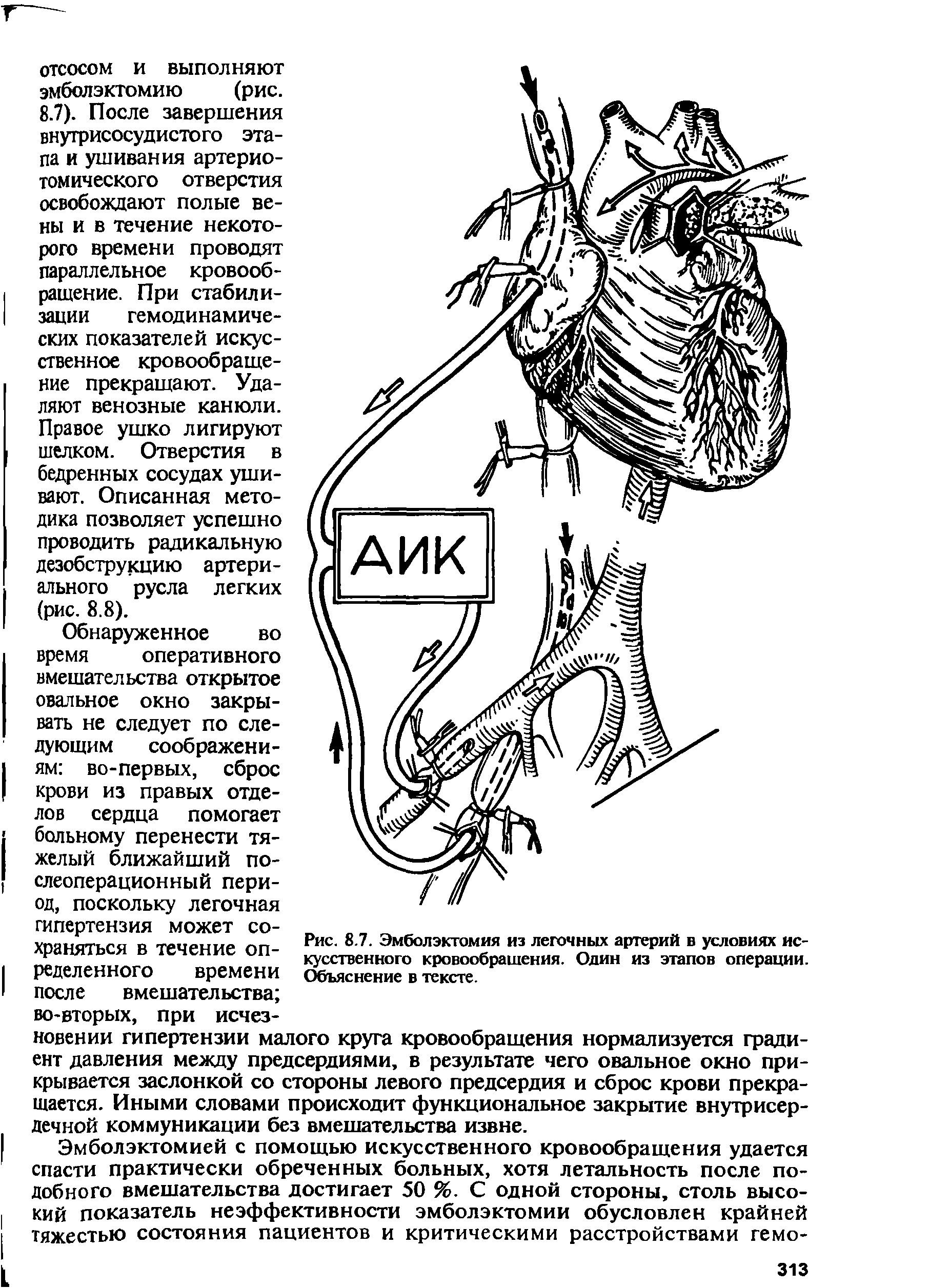 Рис. 8.7. Эмболэктомия из легочных артерий в условиях искусственного кровообращения. Один из этапов операции. Объяснение в тексте.