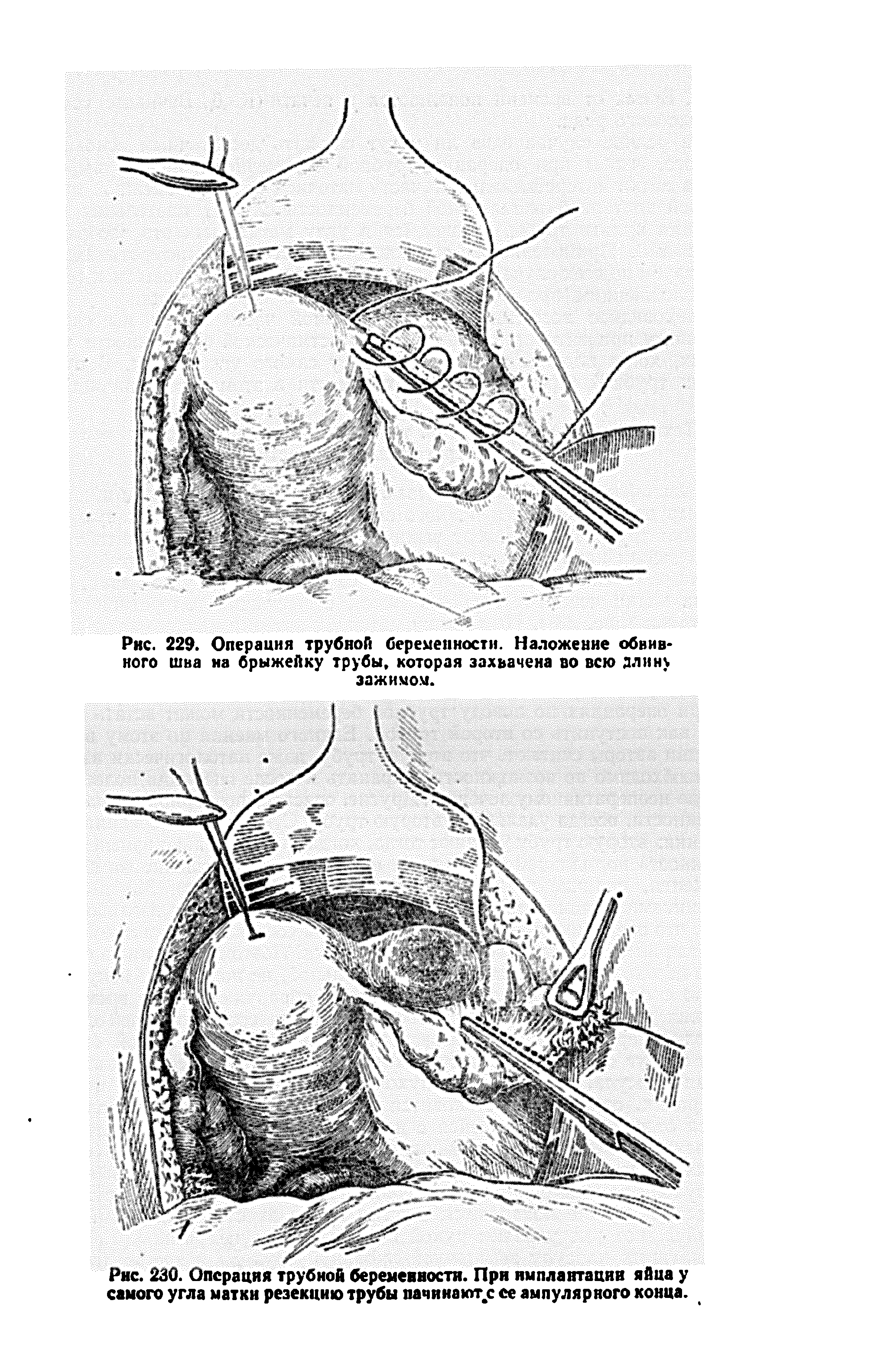 Рис. 230. Операция трубной беременности. При имплантации яйца у самого угла матки резекцию трубы пачинают.с ее ампулярного конца.