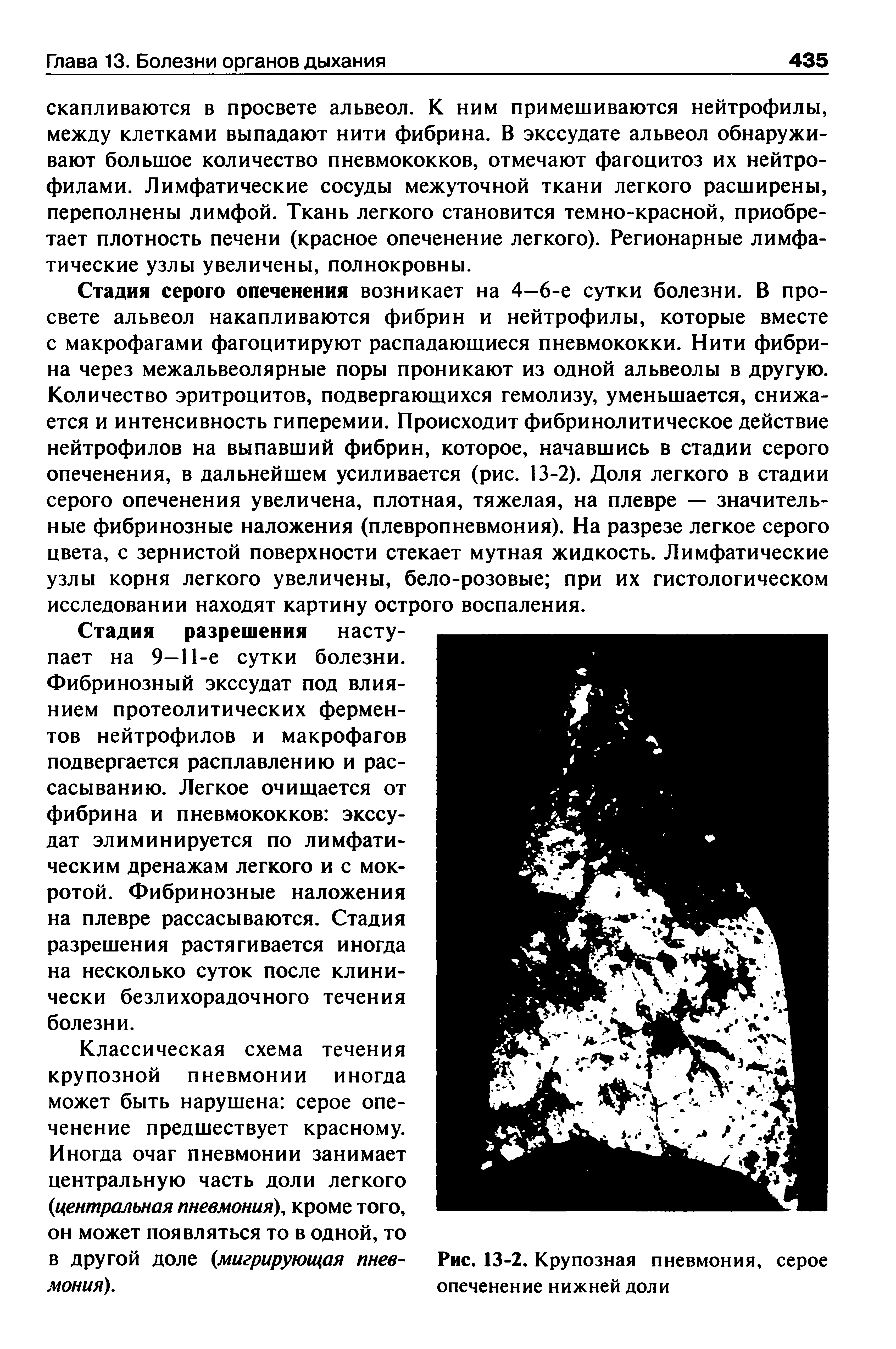 Рис. 13-2. Крупозная пневмония, серое опеченение нижней доли...