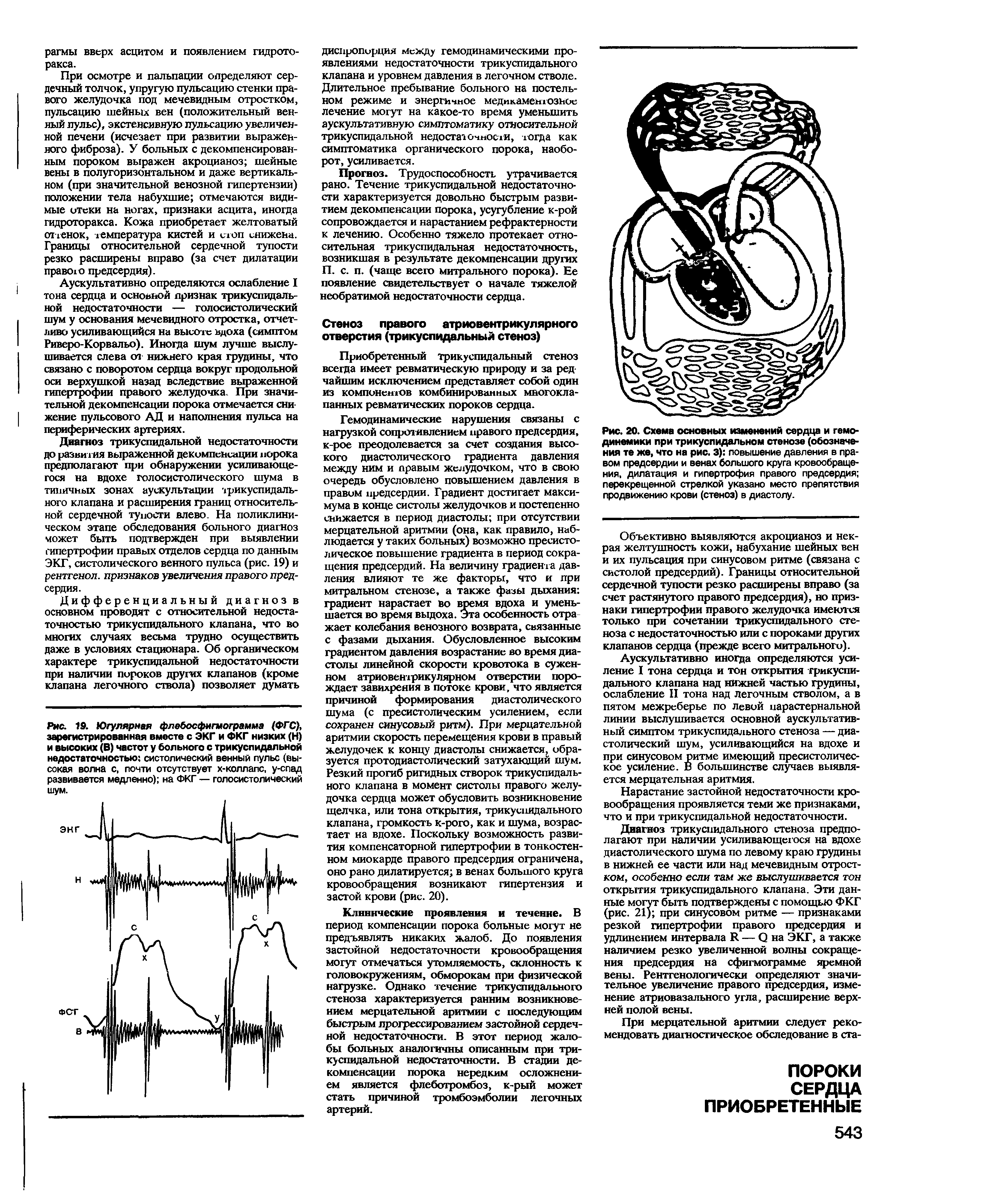 Рис. 19. Югулярная флебосфигмограмма (ФГС), зарегистрированная вместе с ЭКГ и ФКГ низких (Н) и высоких (В) частот у больного с трикуспидальной недостаточностью систолический венный пульс (высокая волна с, почти отсутствует х-коллапс, у-спад...