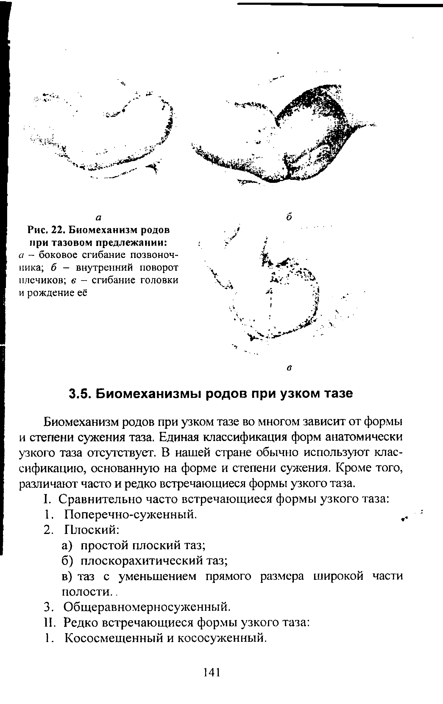 Рис. 22. Биомеханизм родов при тазовом предлежании а - боковое сгибание позвоночника б - внутренний поворот плечиков в - сгибание головки и рождение её...