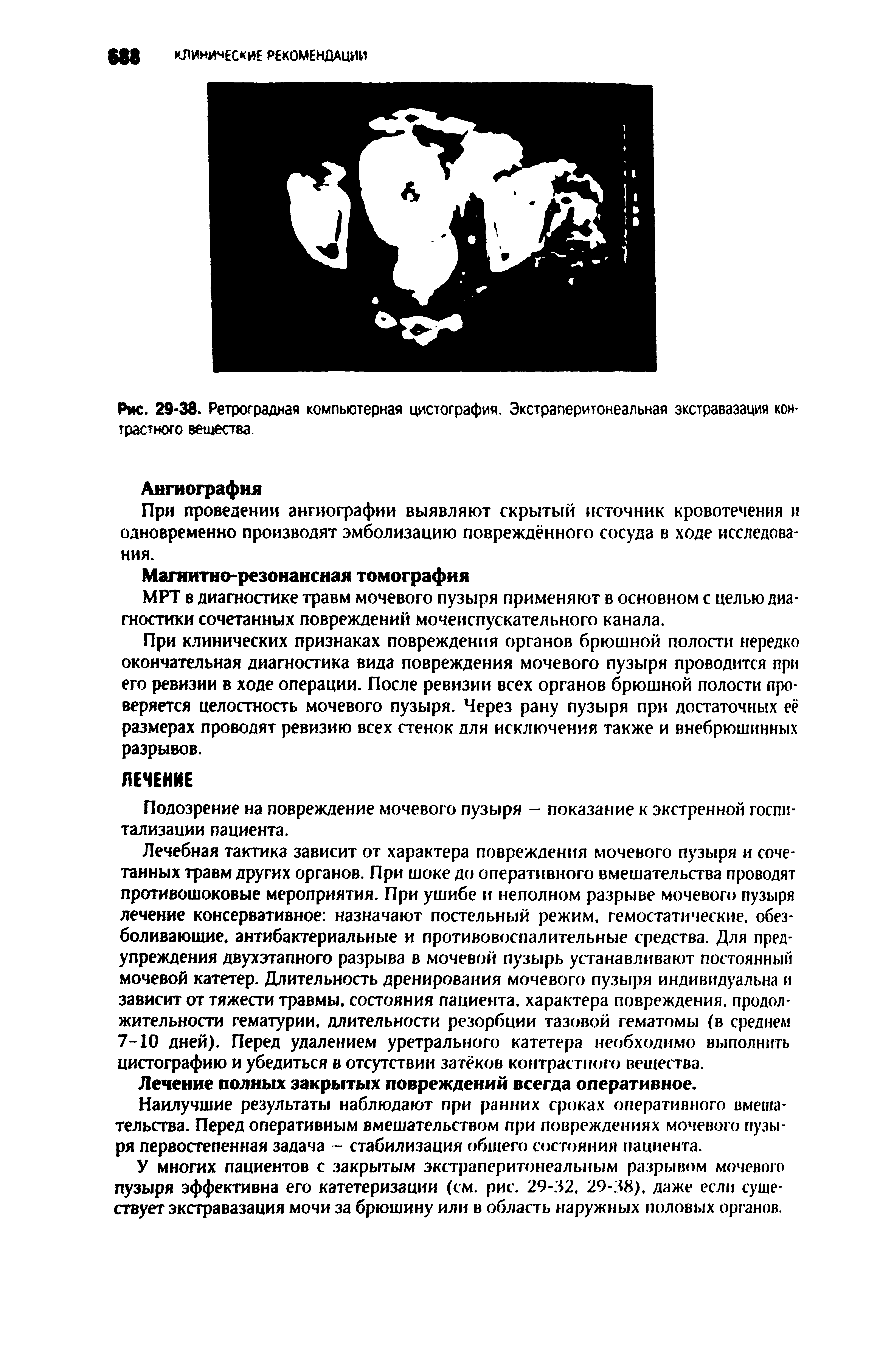 Рис. 29-38. Ретроградная компьютерная цистография. Экстраперитонеальная экстравазация контрастного вещества...