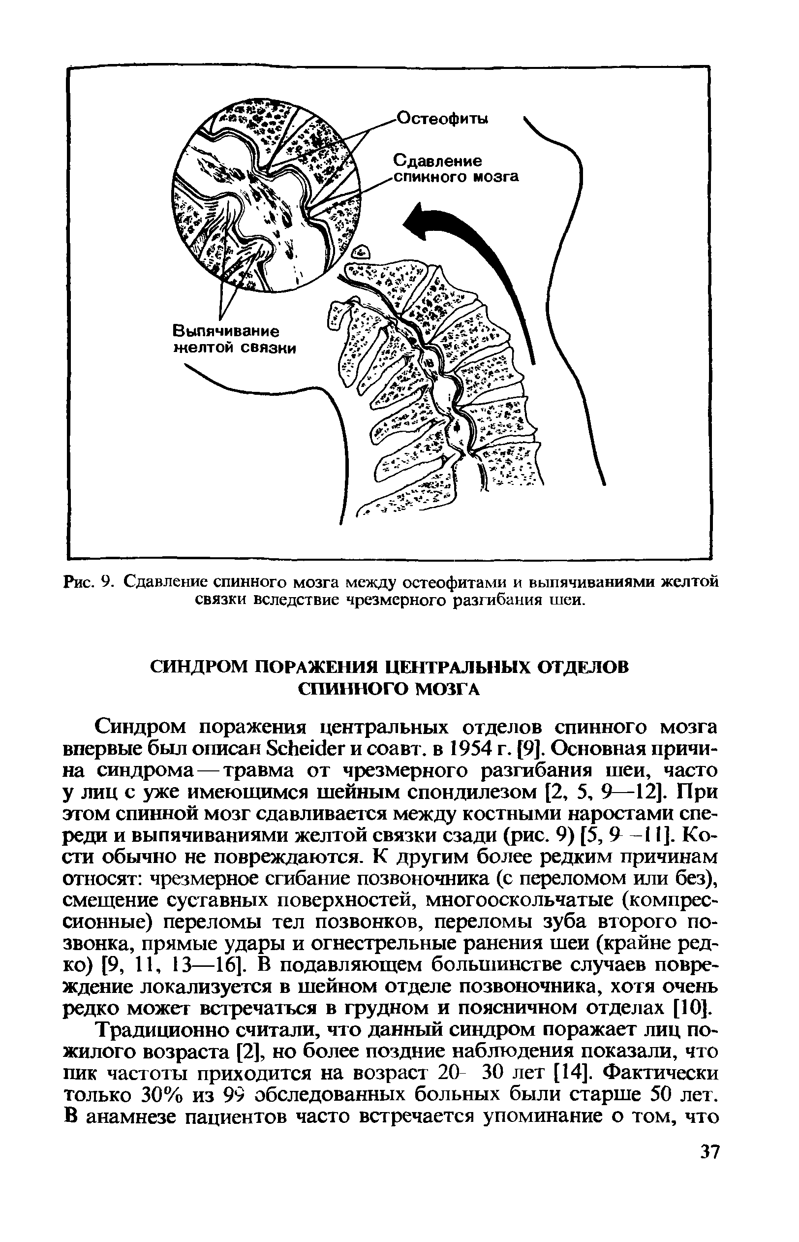 Рис. 9. Сдавление спинного мозга между остеофитами и выпячиваниями желтой связки вследствие чрезмерного разгибания шеи.