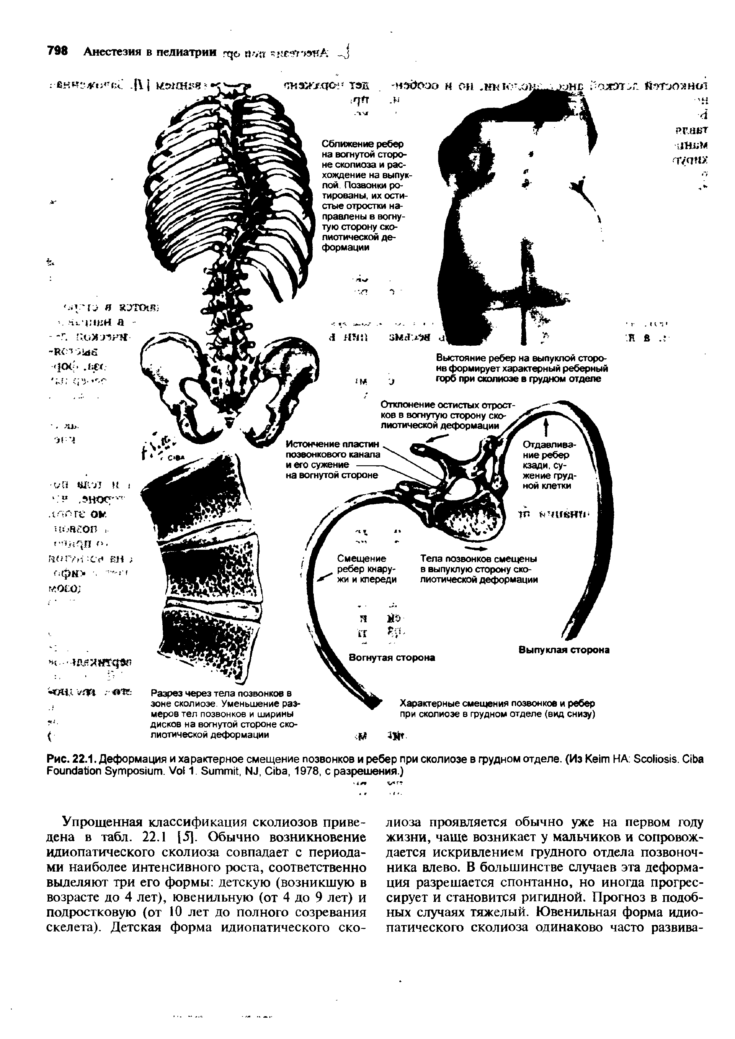 Рис. 22.1. Деформация и характерное смещение позвонков и ребер при сколиозе в грудном отделе. (Из K НА S . C F S . V 1 S , NJ, C , 1978, с разрешения.)...