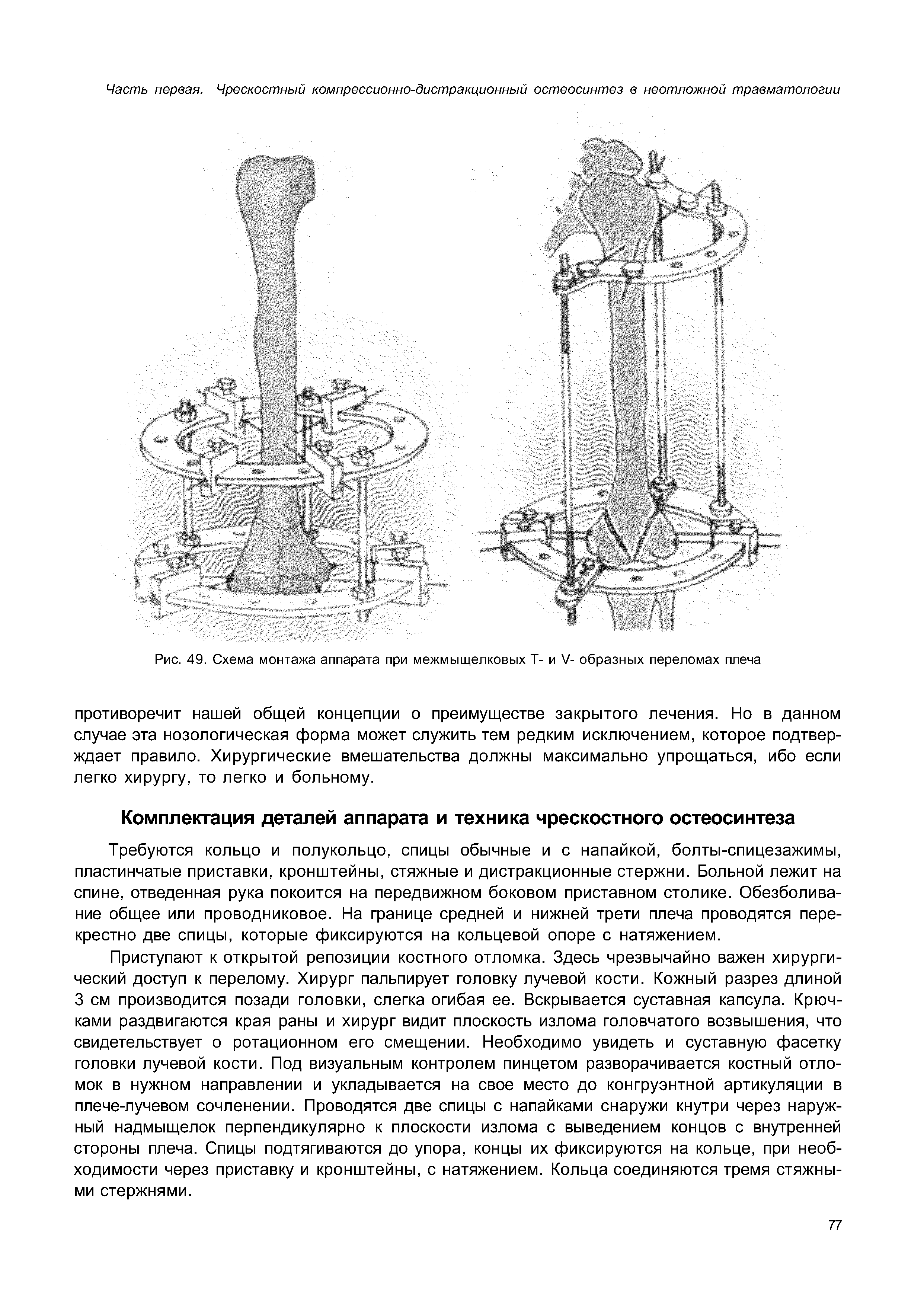 Рис. 49. Схема монтажа аппарата при межмыщелковых Т- и V- образных переломах плеча...