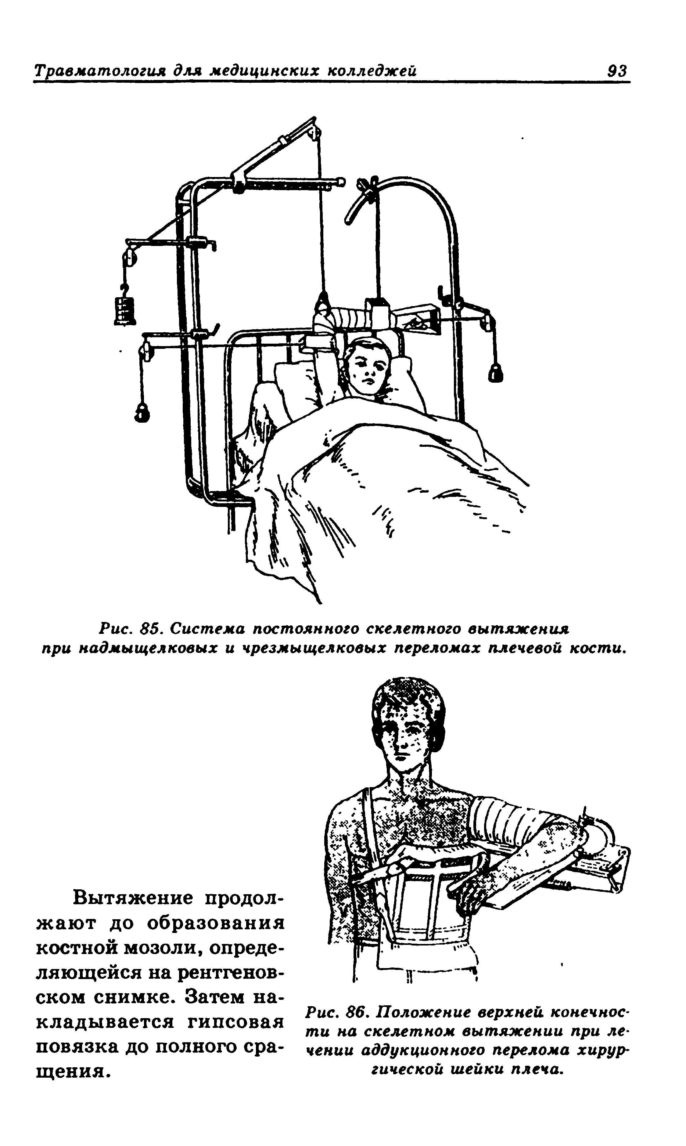 Рис. 85. Система постоянного скелетного вытяжения при надмыщелковых и чрезмыщелковых переломах плечевой кости.