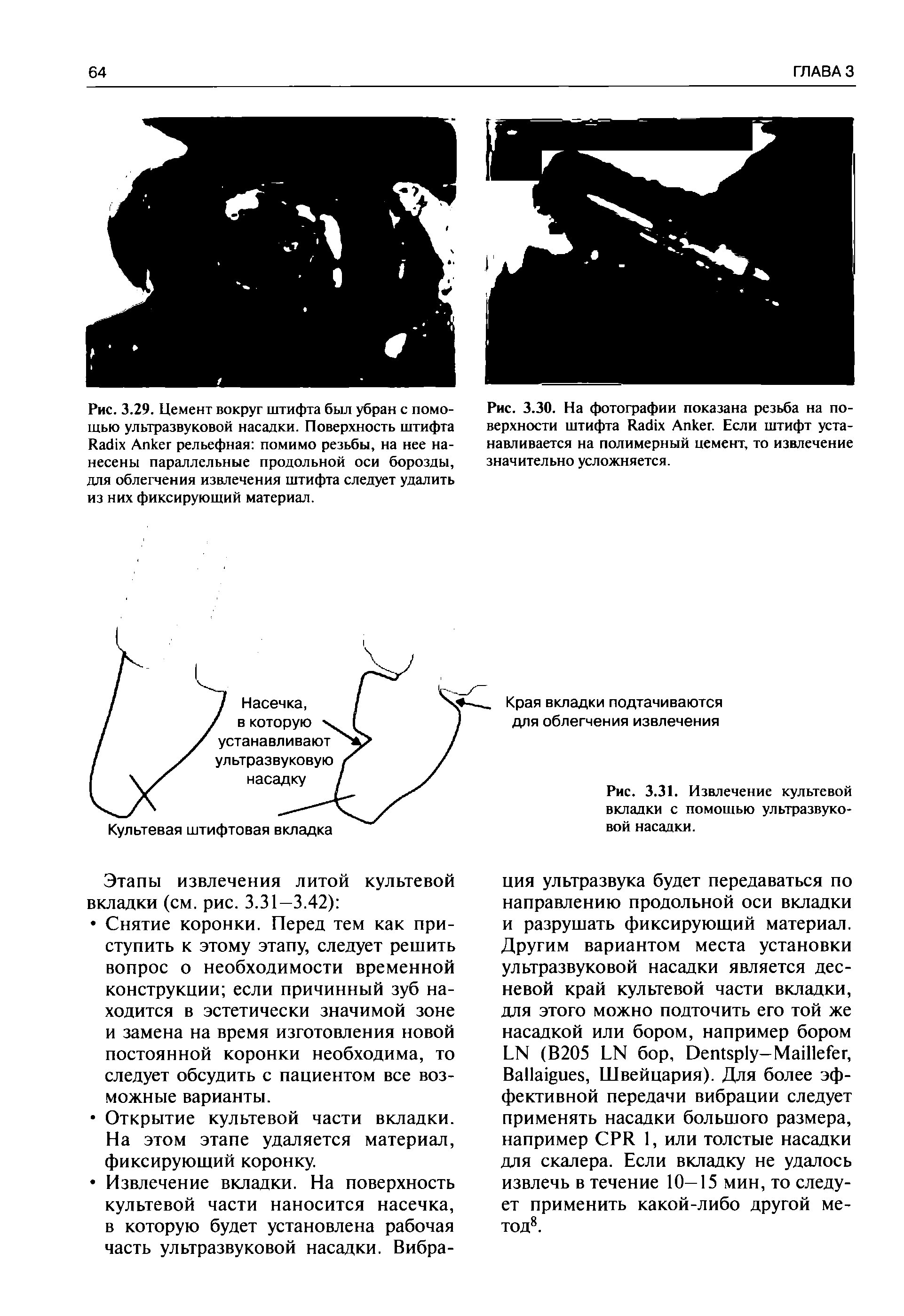 Рис. 3.29. Цемент вокруг штифта был убран с помощью ультразвуковой насадки. Поверхность штифта R A рельефная помимо резьбы, на нее нанесены параллельные продольной оси борозды, для облегчения извлечения штифта следует удалить из них фиксирующий материал.