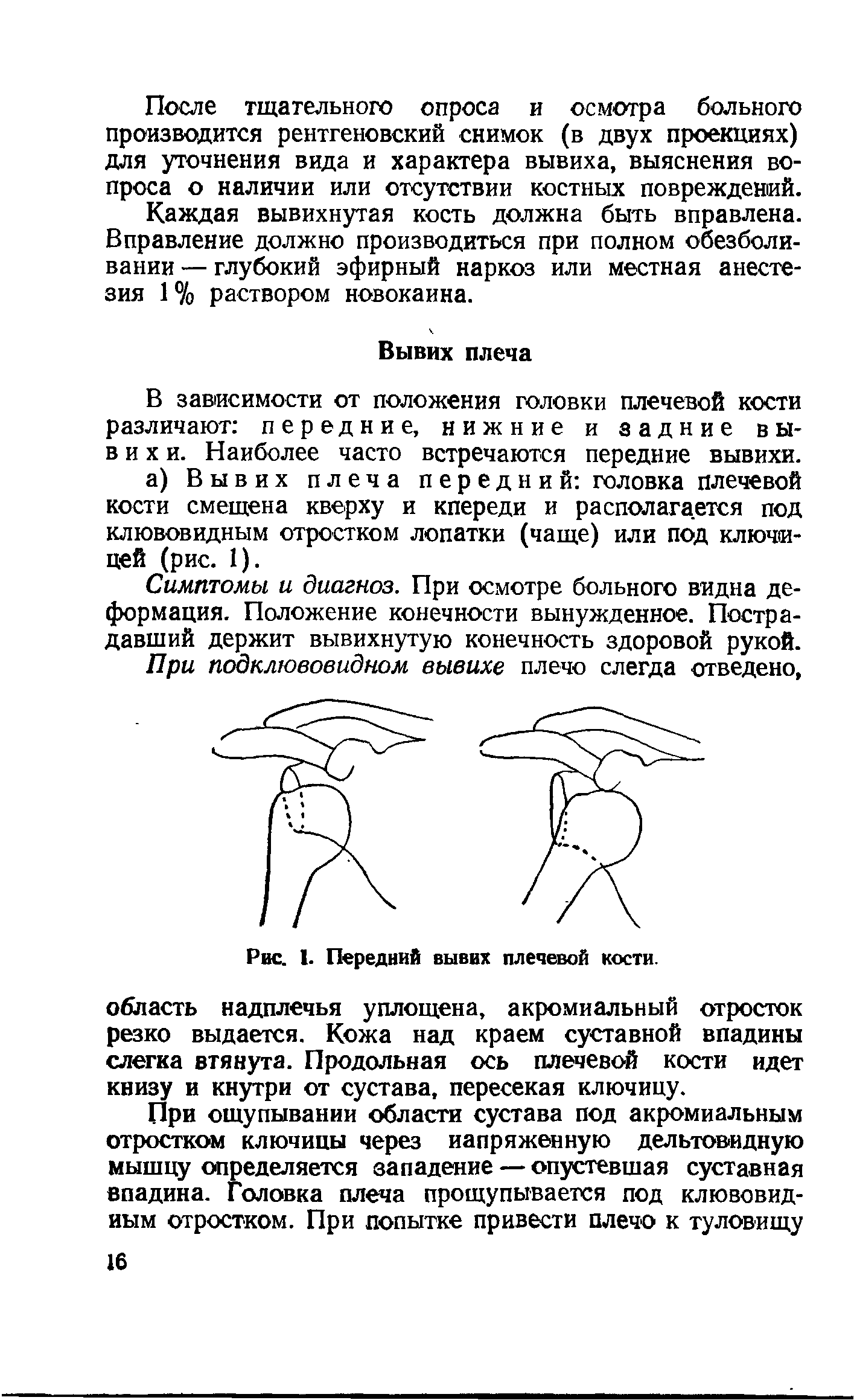 Рис. I. Передний вывих плечевой кости, область надплечья уплощена, акромиальный отросток резко выдается. Кожа над краем суставной впадины слегка втянута. Продольная ось плечевой кости идет книзу и кнутри от сустава, пересекая ключицу.