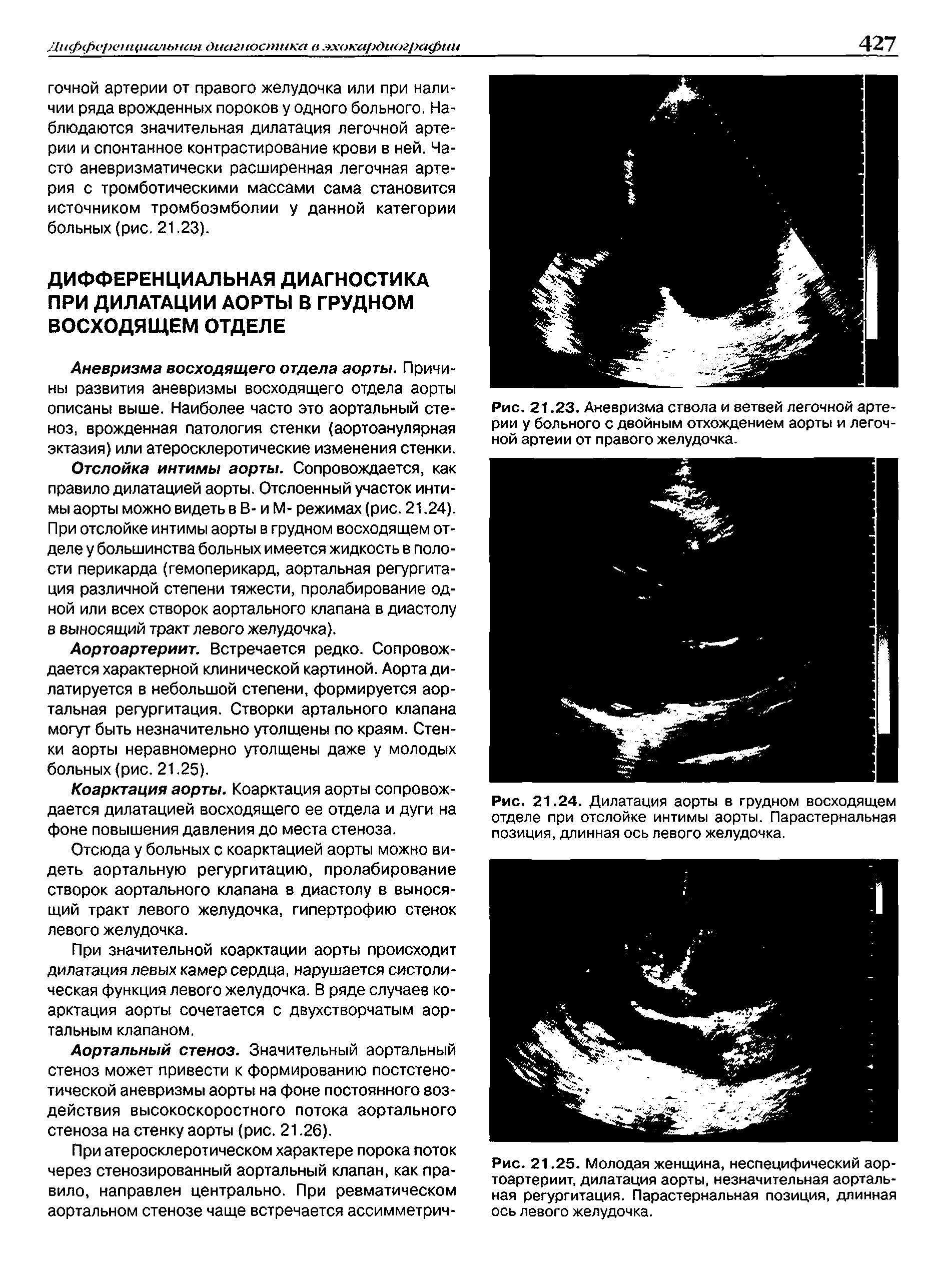 Рис. 21.25. Молодая женщина, неспецифический аортоартериит, дилатация аорты, незначительная аортальная регургитация. Парастернальная позиция, длинная ось левого желудочка.