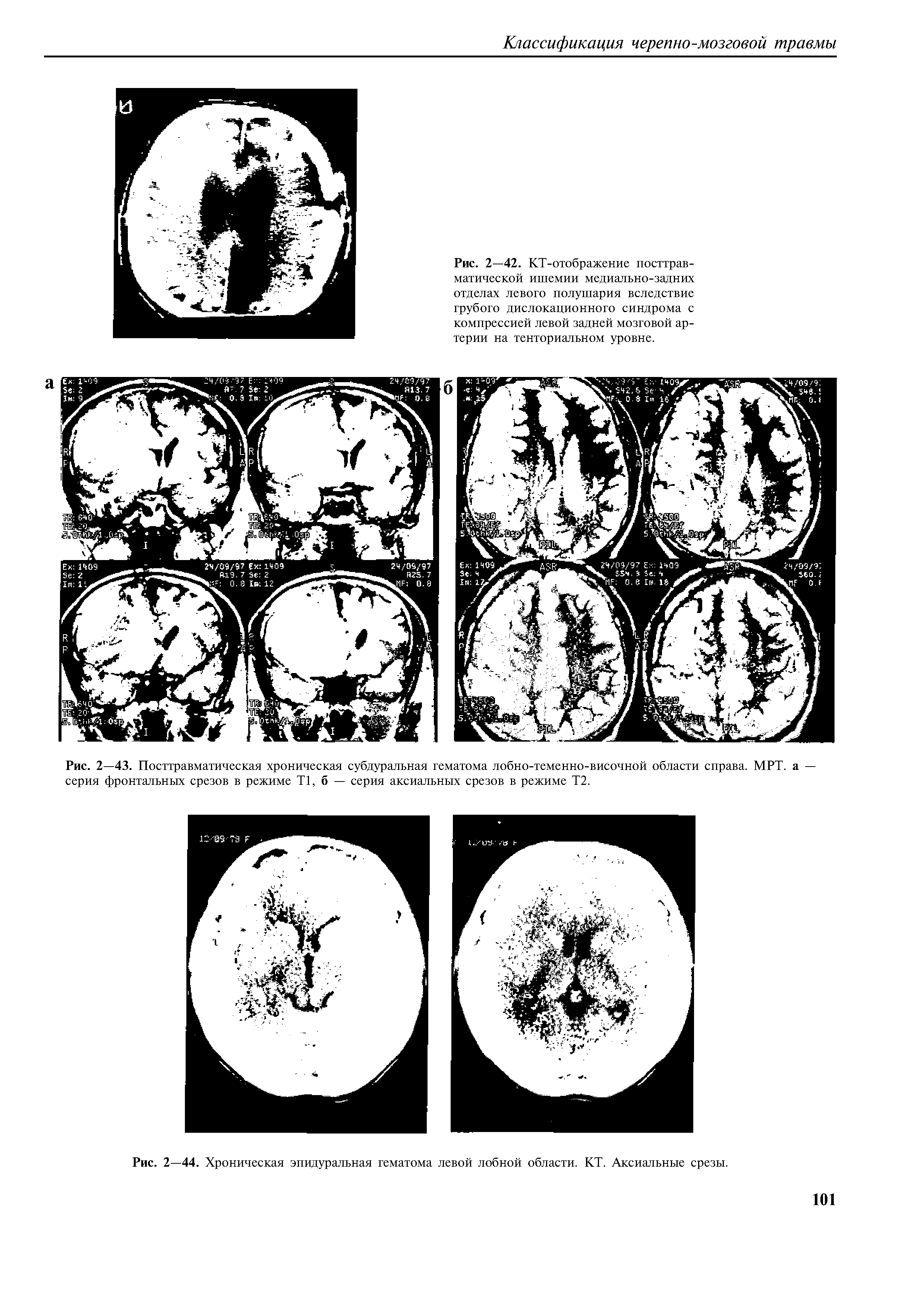 Рис. 2—44. Хроническая эпидуральная гематома левой лобной области. КТ. Аксиальные срезы.