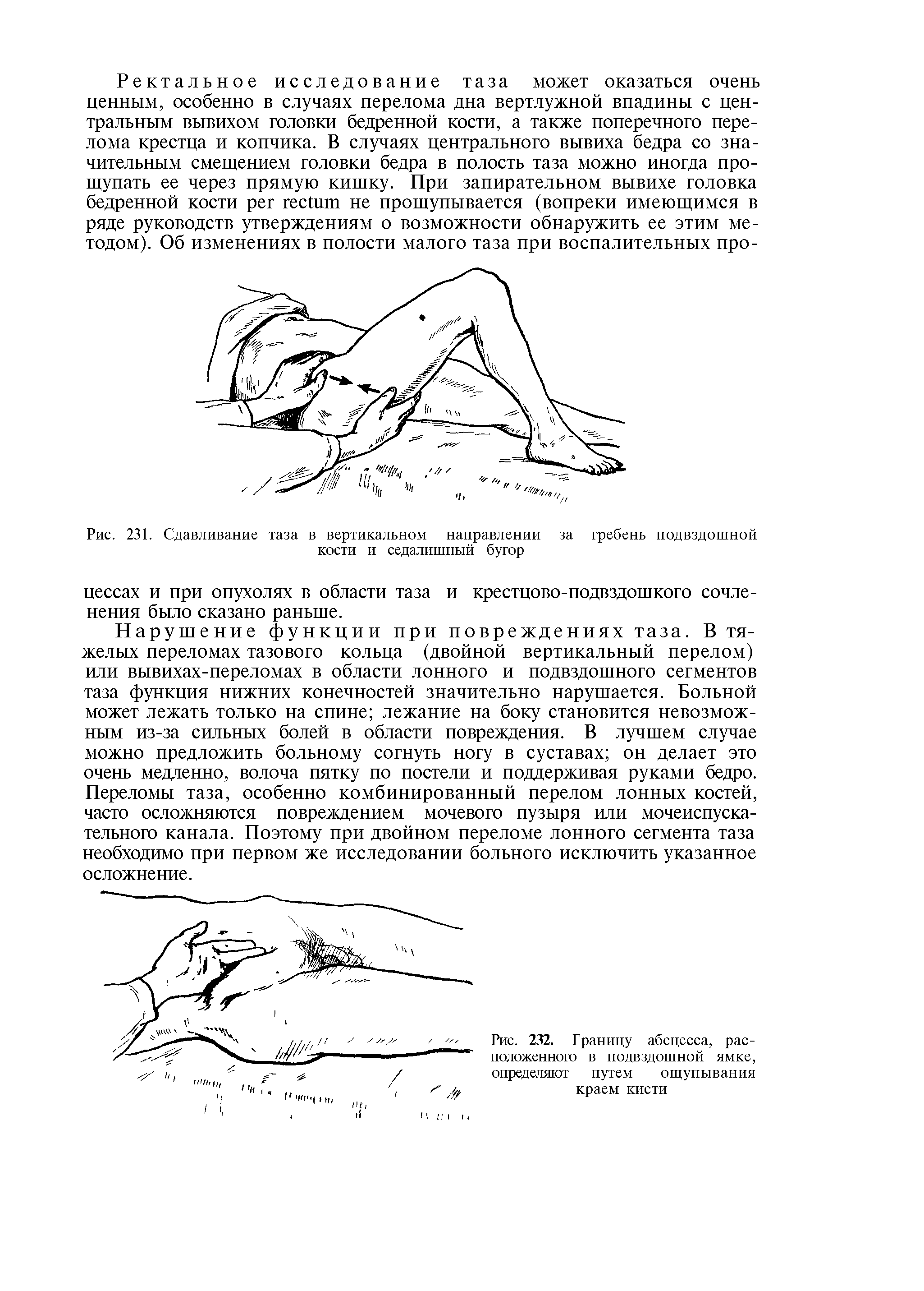Рис. 231. Сдавливание таза в вертикальном направлении за гребень подвздошной кости и седалищный бугор...
