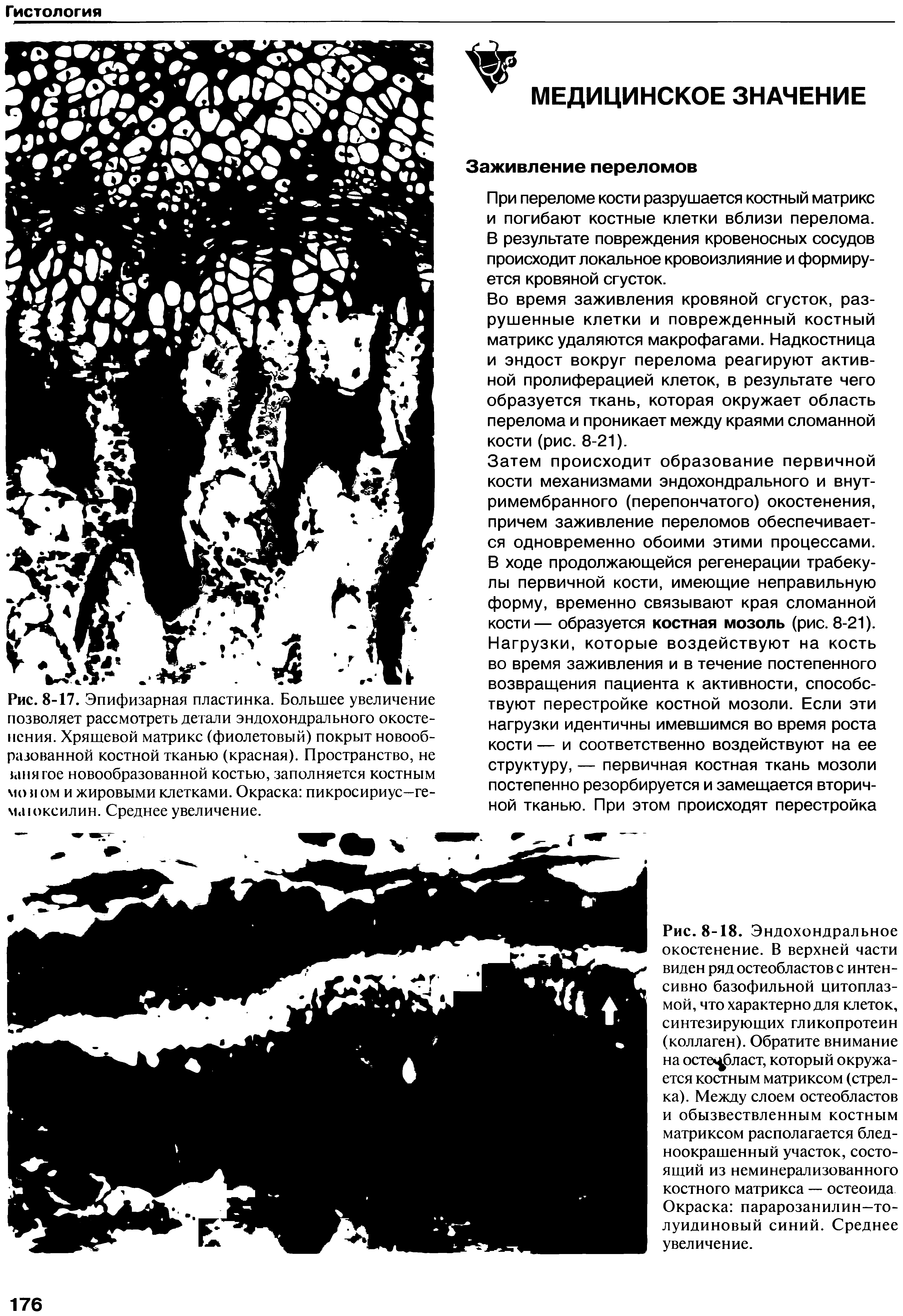 Рис. 8-17. Эпифизарная пластинка. Большее увеличение позволяет рассмотреть детали эндохондрального окостенения. Хрящевой матрикс (фиолетовый) покрыт новообразованной костной тканью (красная). Пространство, не шня гое новообразованной костью, заполняется костным мо я ом и жировыми клетками. Окраска пикросириус—гема юксилин. Среднее увеличение.