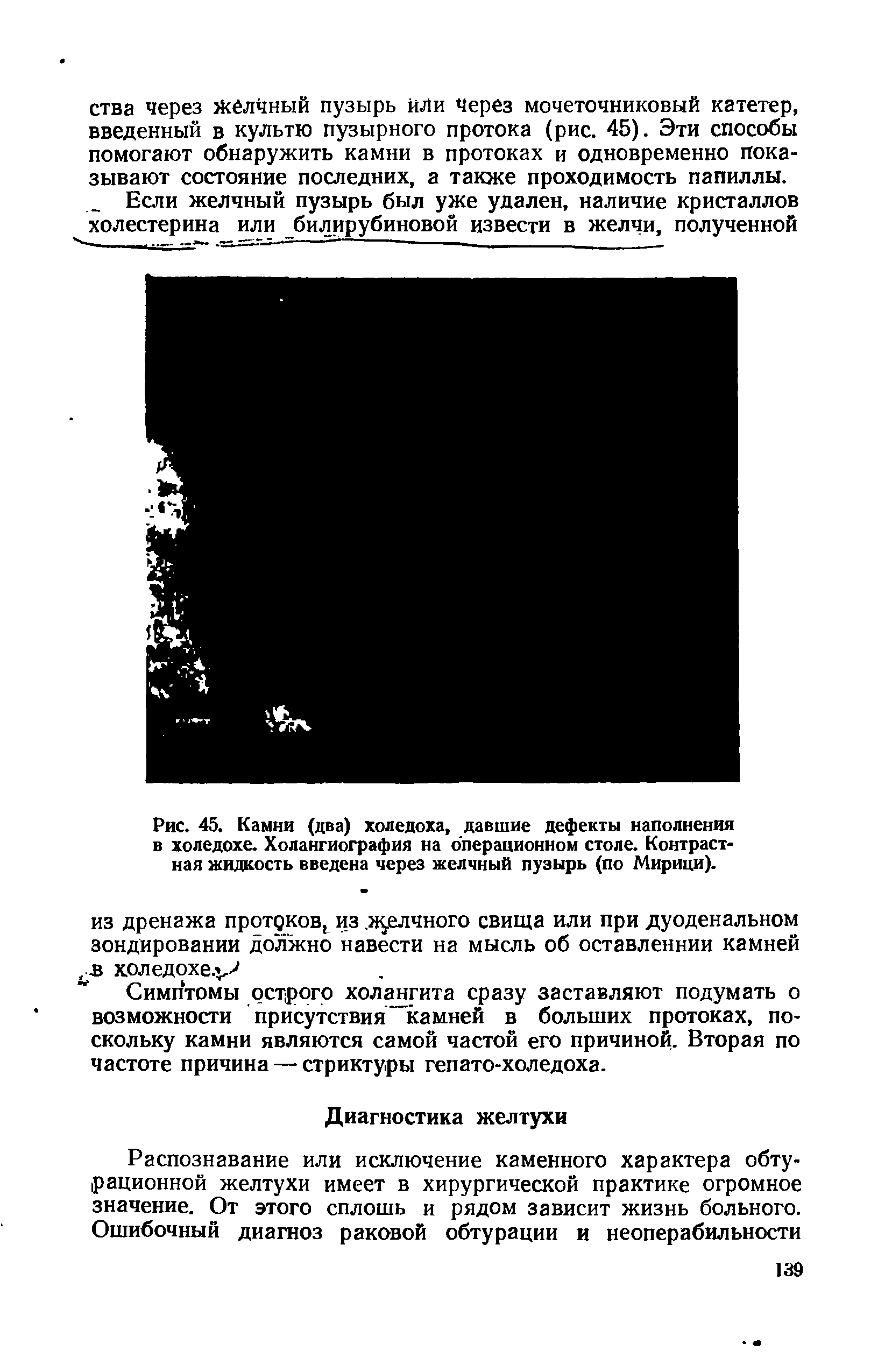 Рис. 45. Камни (два) холедоха, давшие дефекты наполнения в холедохе. Холангиография на операционном столе. Контрастная жидкость введена через желчный пузырь (по Мирици).