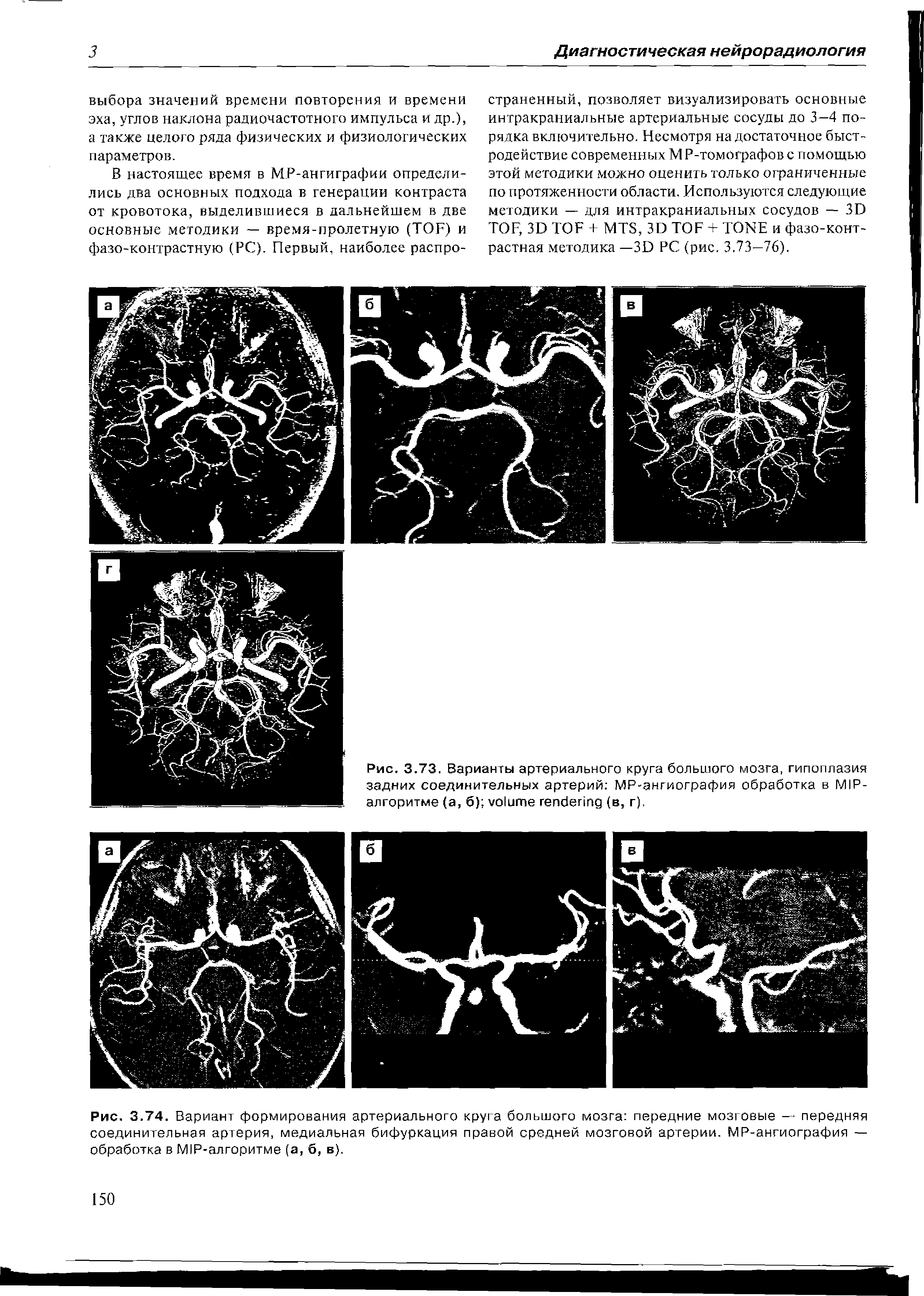 Рис. 3.74. Вариант формирования артериального круга большого мозга передние мозговые — передняя соединительная артерия, медиальная бифуркация правой средней мозговой артерии. МР-ангиография — обработка в М1Р-алгоритме (а, б, в).