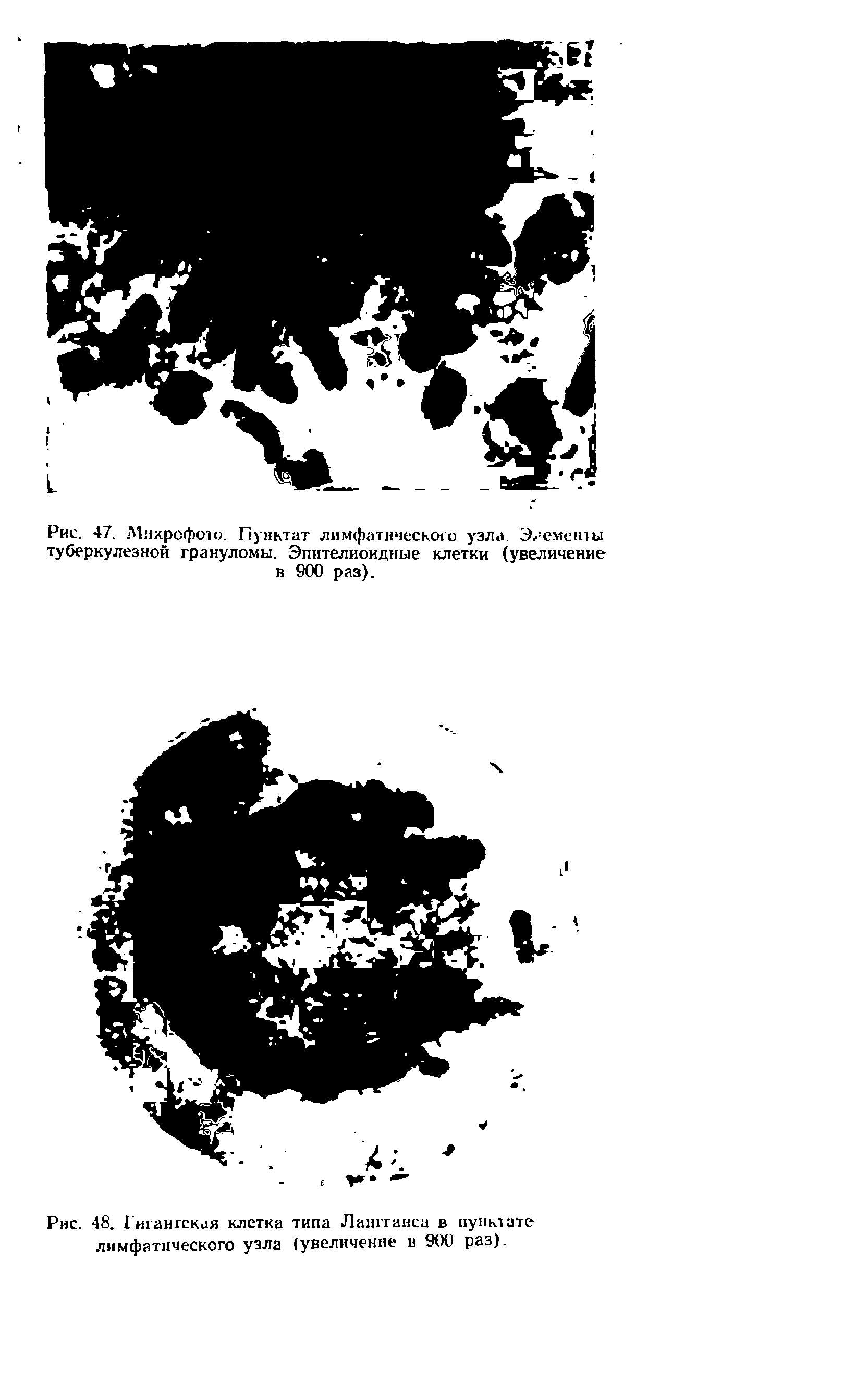 Рис. 48. Гигантская клетка типа Лангганса в пунктате лимфатического узла (увеличение и 900 раз).