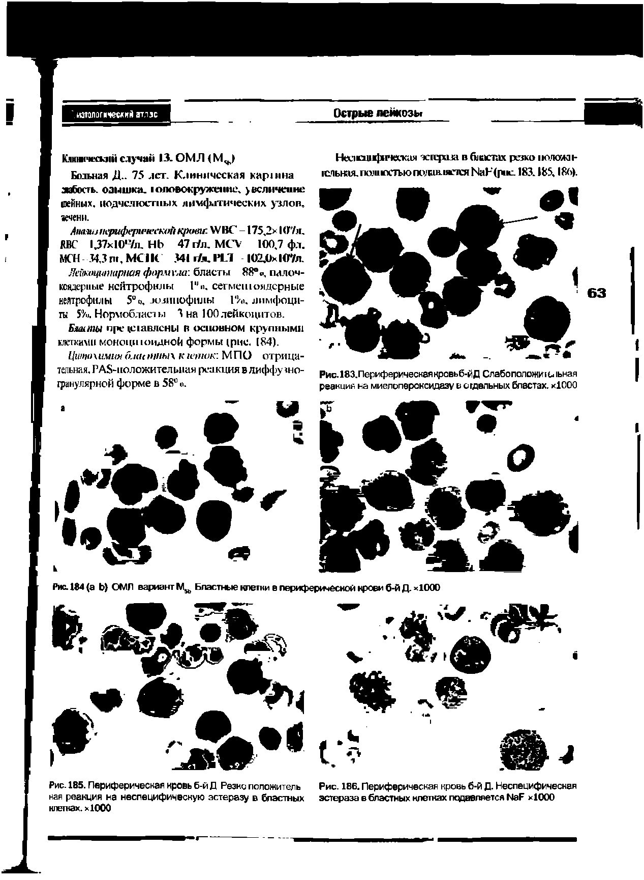 Рис. 185. Периферическая кровь б-й Д Резко положитель Рис. 186. Периферическая кровь б-й Д. Неспецифическая пая реакция на неспецифическую эстеразу в бластных эстераза в бластных клетках подавляется >1000...