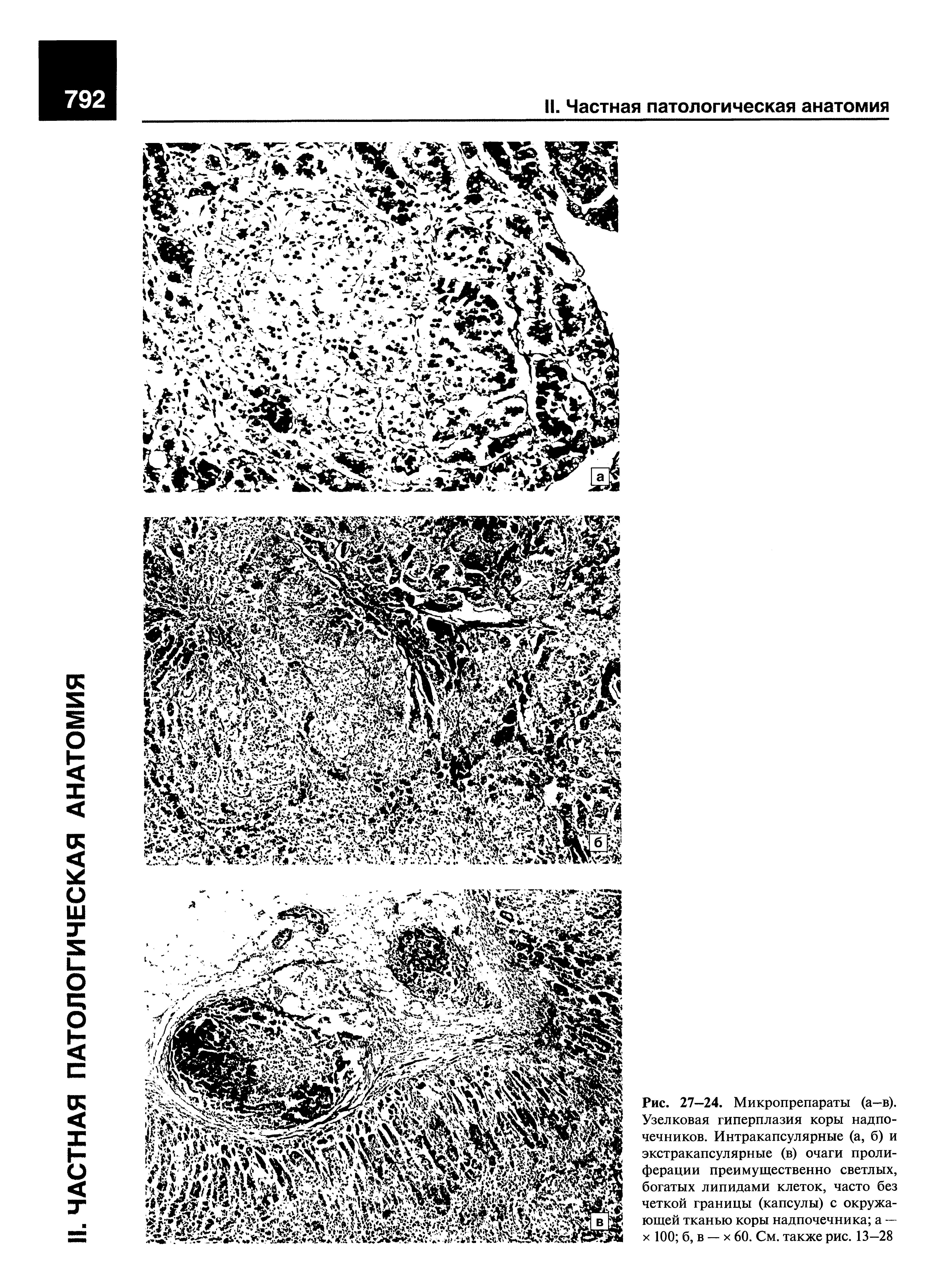 Рис. 27—24. Микропрепараты (а—в). Узелковая гиперплазия коры надпочечников. Интракапсулярные (а, б) и экстракапсулярные (в) очаги пролиферации преимущественно светлых, богатых липидами клеток, часто без четкой границы (капсулы) с окружающей тканью коры надпочечника а —-х 100 б, в — х 60. См. также рис. 13—28...