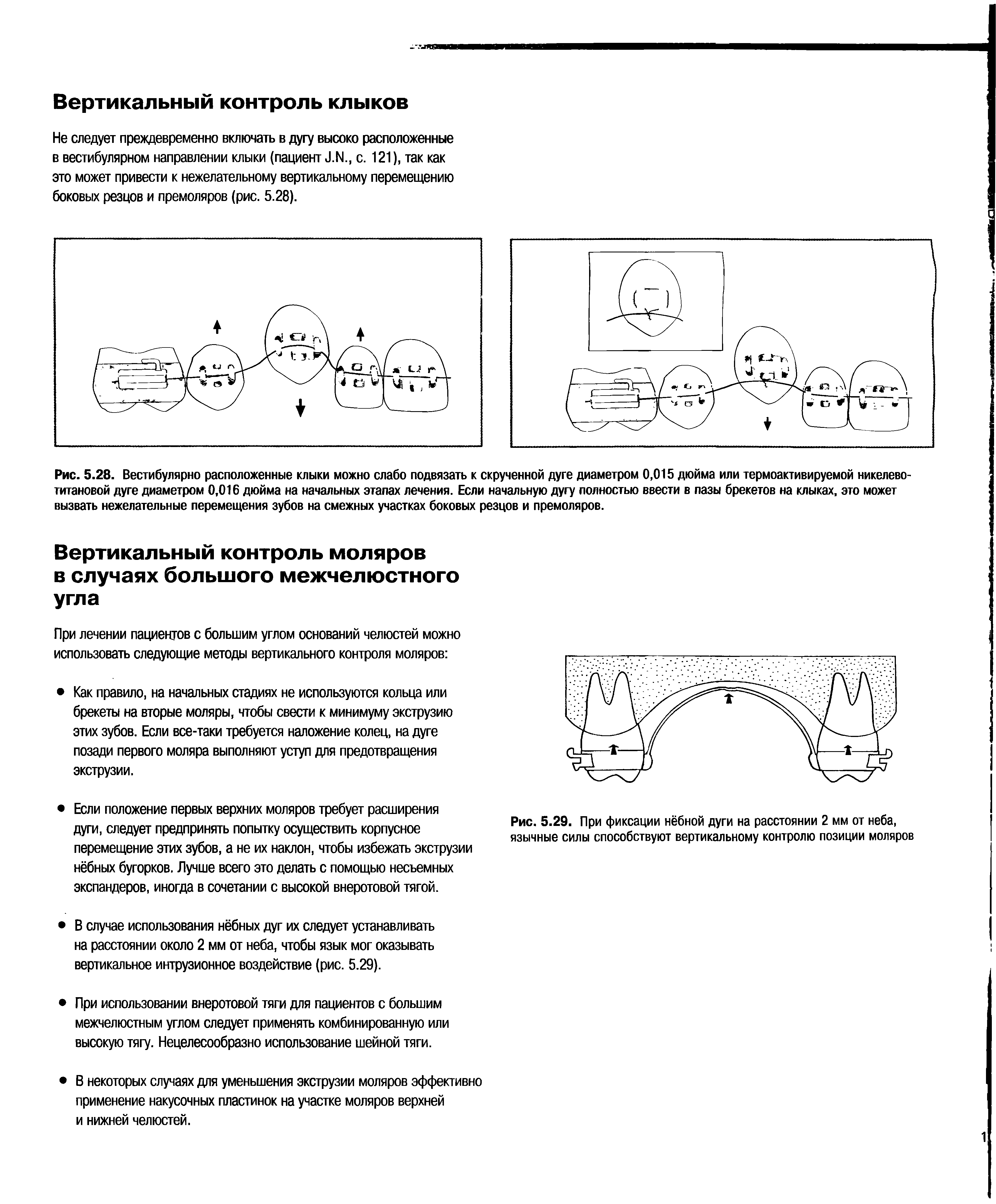Рис. 5.29. При фиксации нёбной дуги на расстоянии 2 мм от неба, язычные силы способствуют вертикальному контролю позиции моляров...