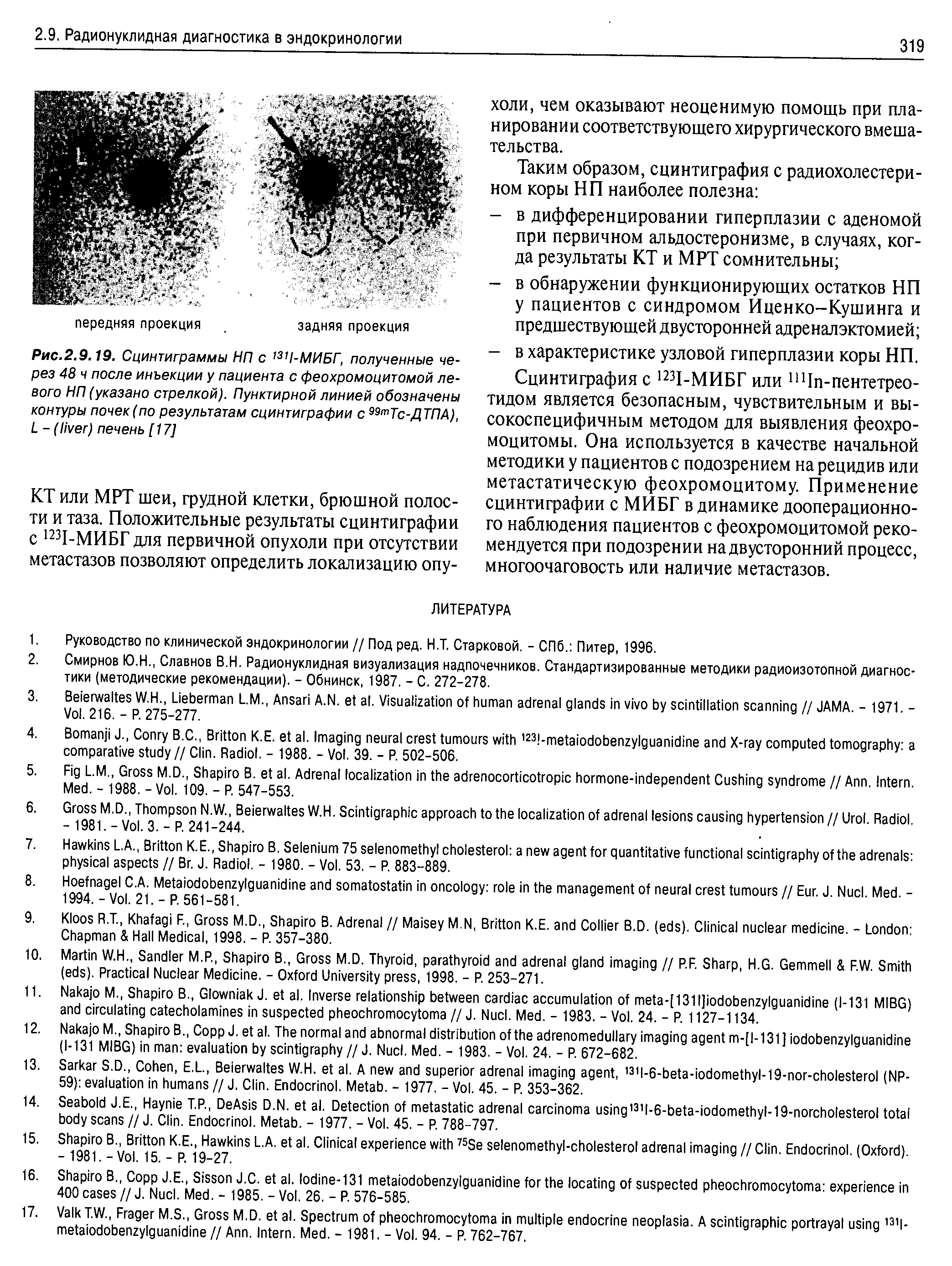 Рис.2.9.19. Сцинтиграммы НП с 13,1-МИБГ, полученные через 48 ч после инъекции у пациента с феохромоцитомой левого НП (указано стрелкой). Пунктирной линией обозначены контуры почек(по результатам сцинтиграфии с 99тТс-ДТПА), L - ( ) печень [ 17]...