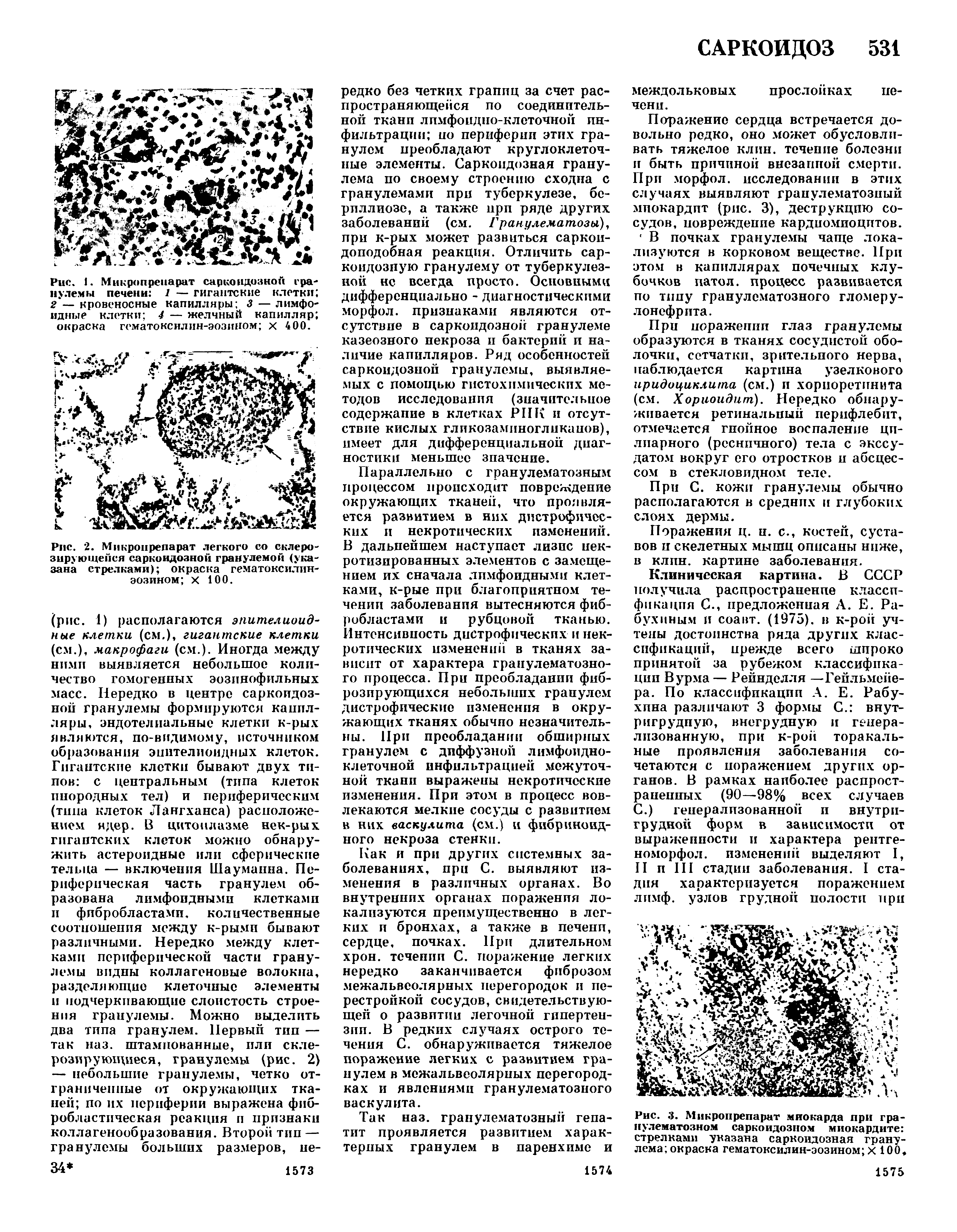 Рис. 1. Микропреиарат саркондозной гранулемы печени 1 — гигантские клетки 2 — кровеносные капилляры 3 — лимфоидные клетки 4 — желчный капилляр окраска гематоксилин-эозином х 400.