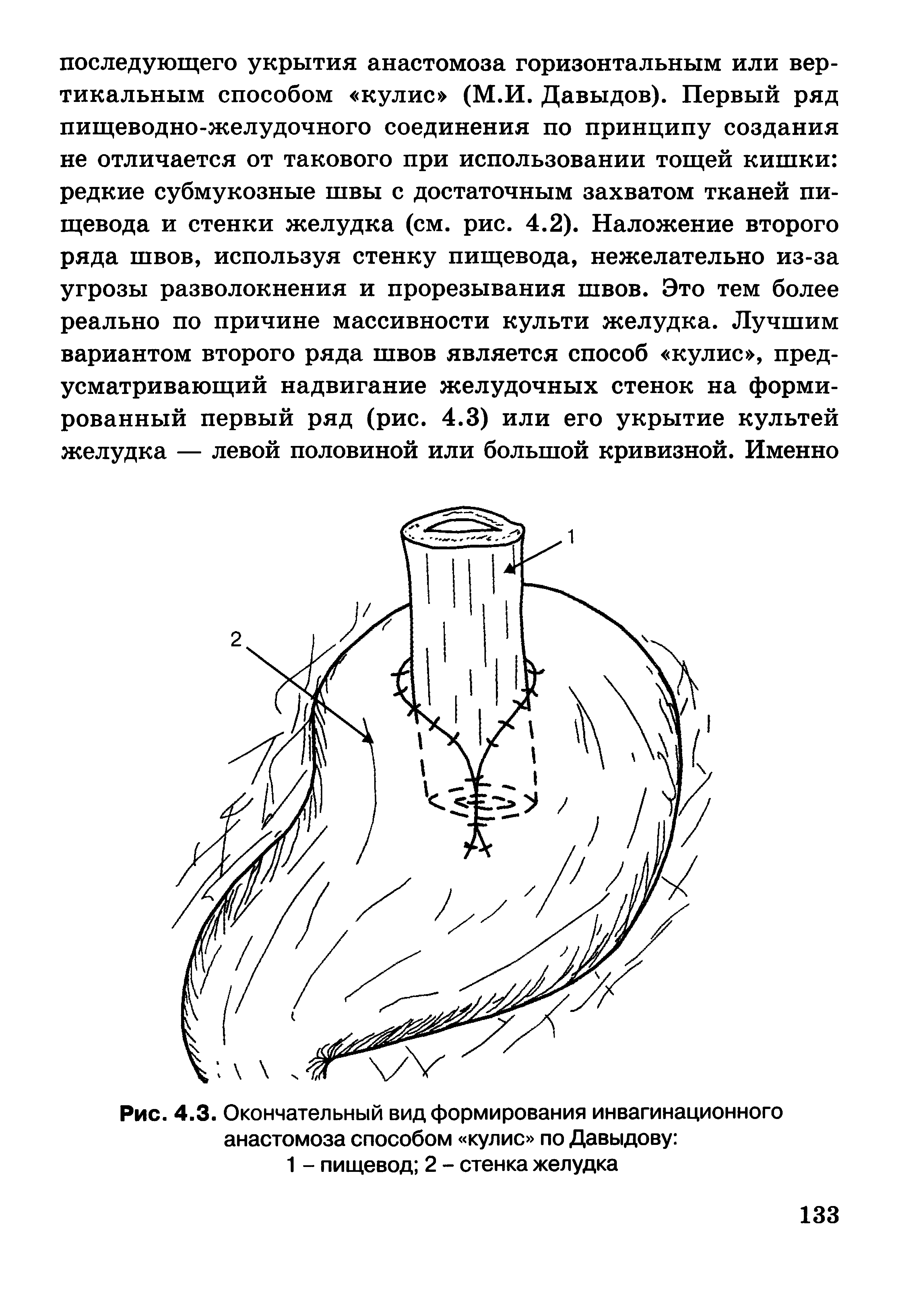 Рис. 4.3. Окончательный вид формирования инвагинационного анастомоза способом кулис по Давыдову ...