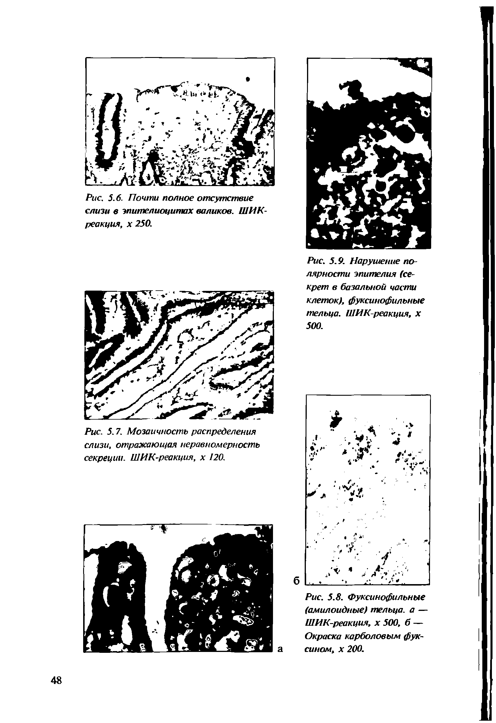 Рис. 5.8. Фуксинофильные (амилоидные) тельца, а — ШИК-реакция, х 500, б — Окраска карболовым фуксином, х 200.