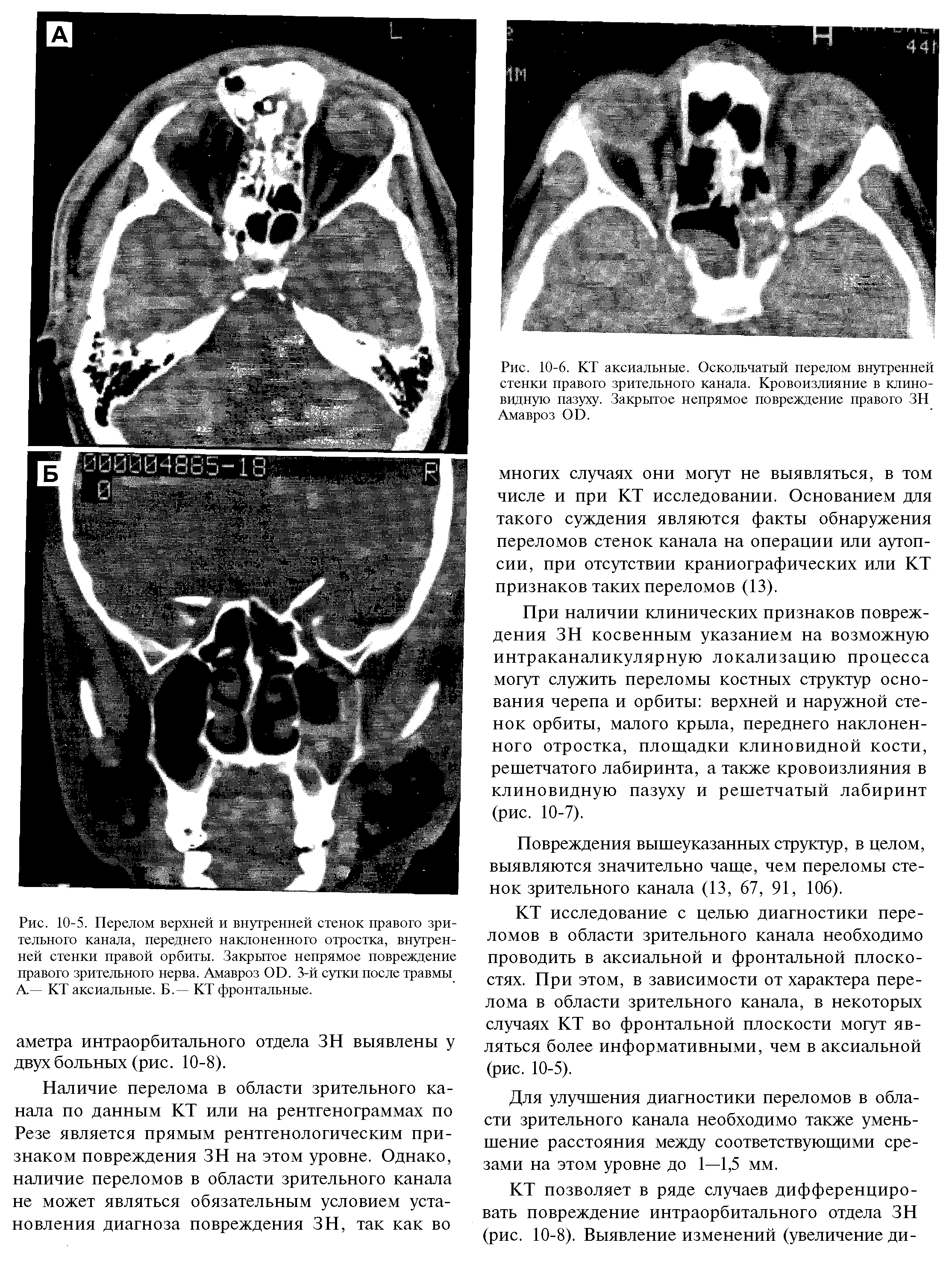 Рис. 10-5. Перелом верхней и внутренней стенок правого зрительного канала, переднего наклоненного отростка, внутренней стенки правой орбиты. Закрытое непрямое повреждение правого зрительного нерва. Амавроз О1). 3-й сутки после травмы А— КТ аксиальные. Б.— КТ фронтальные.