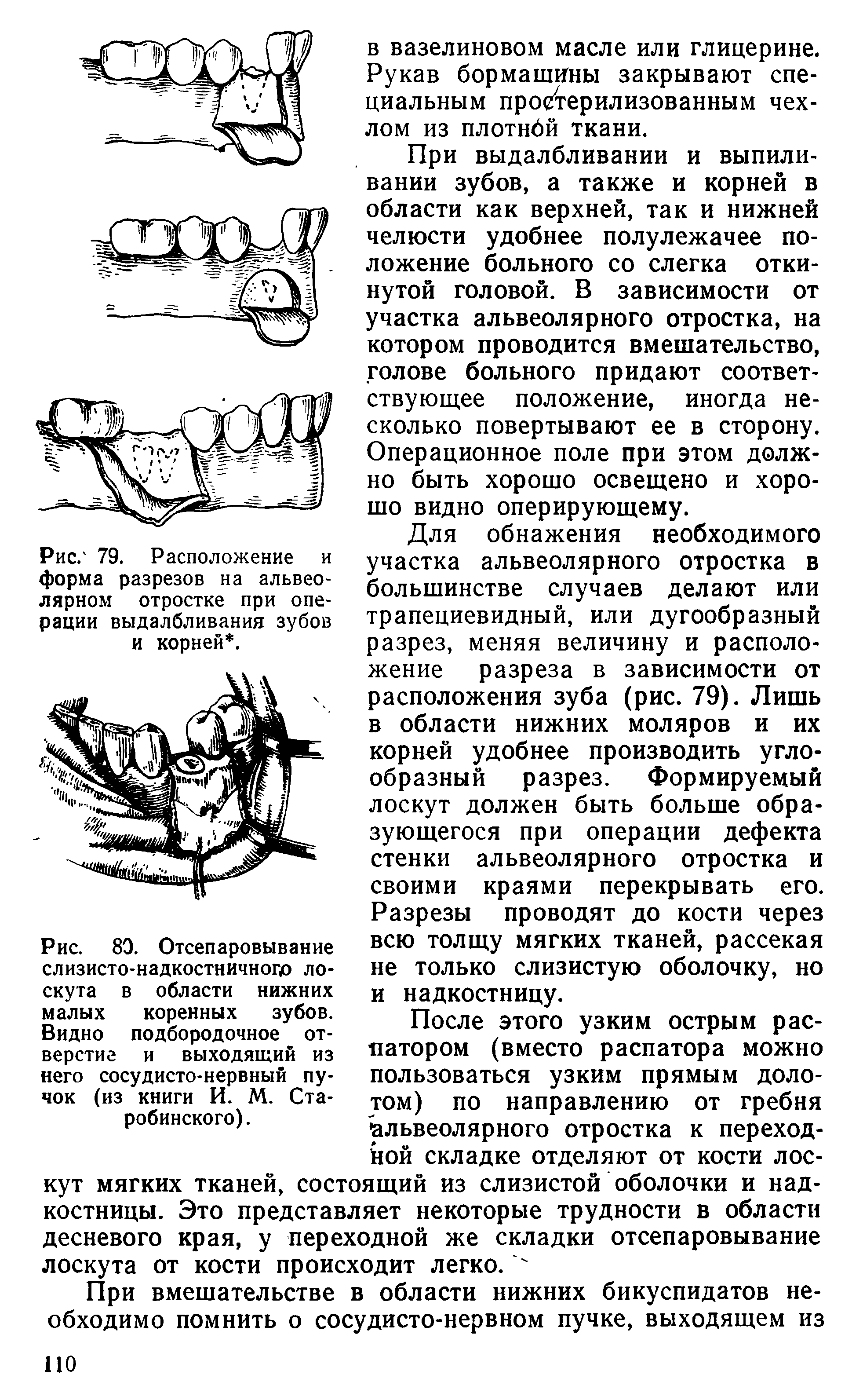 Рис. 80. Отсепаровывание слизисто-надкостничнопо лоскута в области нижних малых коренных зубов. Видно подбородочное отверстие и выходящий из него сосудисто-нервный пучок (из книги И. М. Ста-робинского).